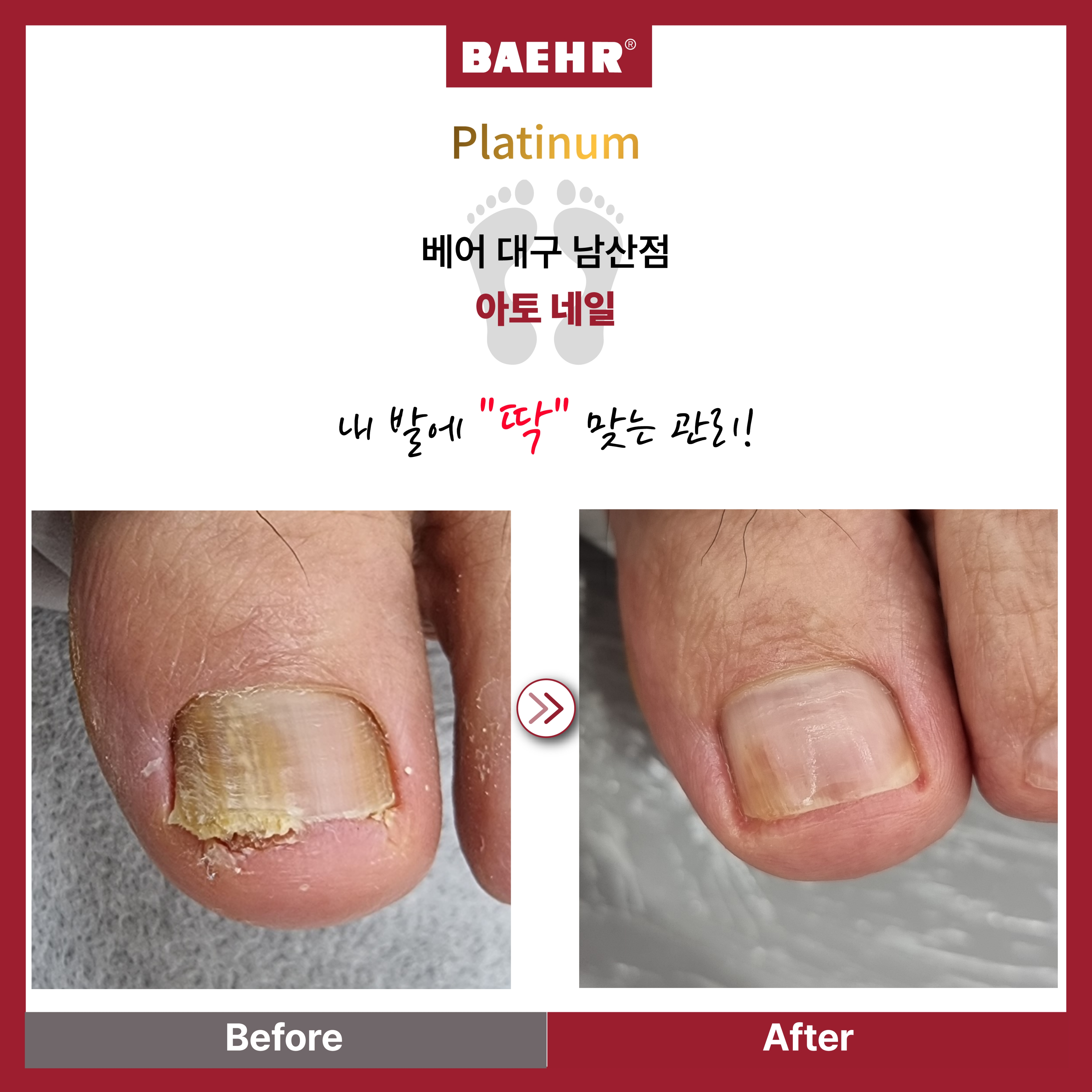 아토네일 & 베어푸스플레게 무좀발톱 내성발톱 대표 이미지