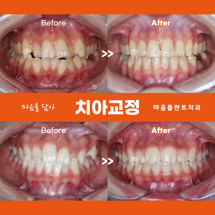 마음플란트치과의원 대표 이미지