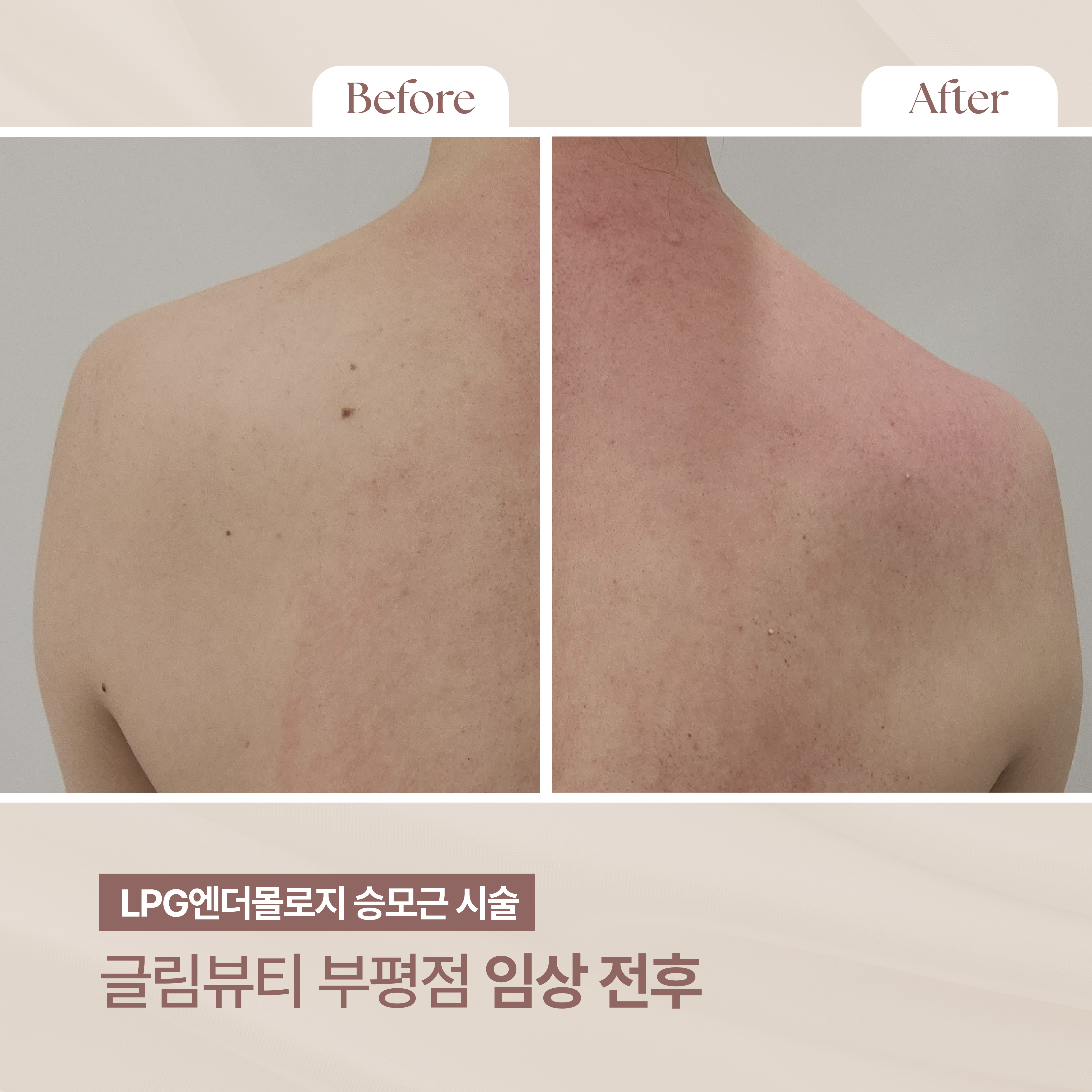 글림뷰티 피부&바디 부평점