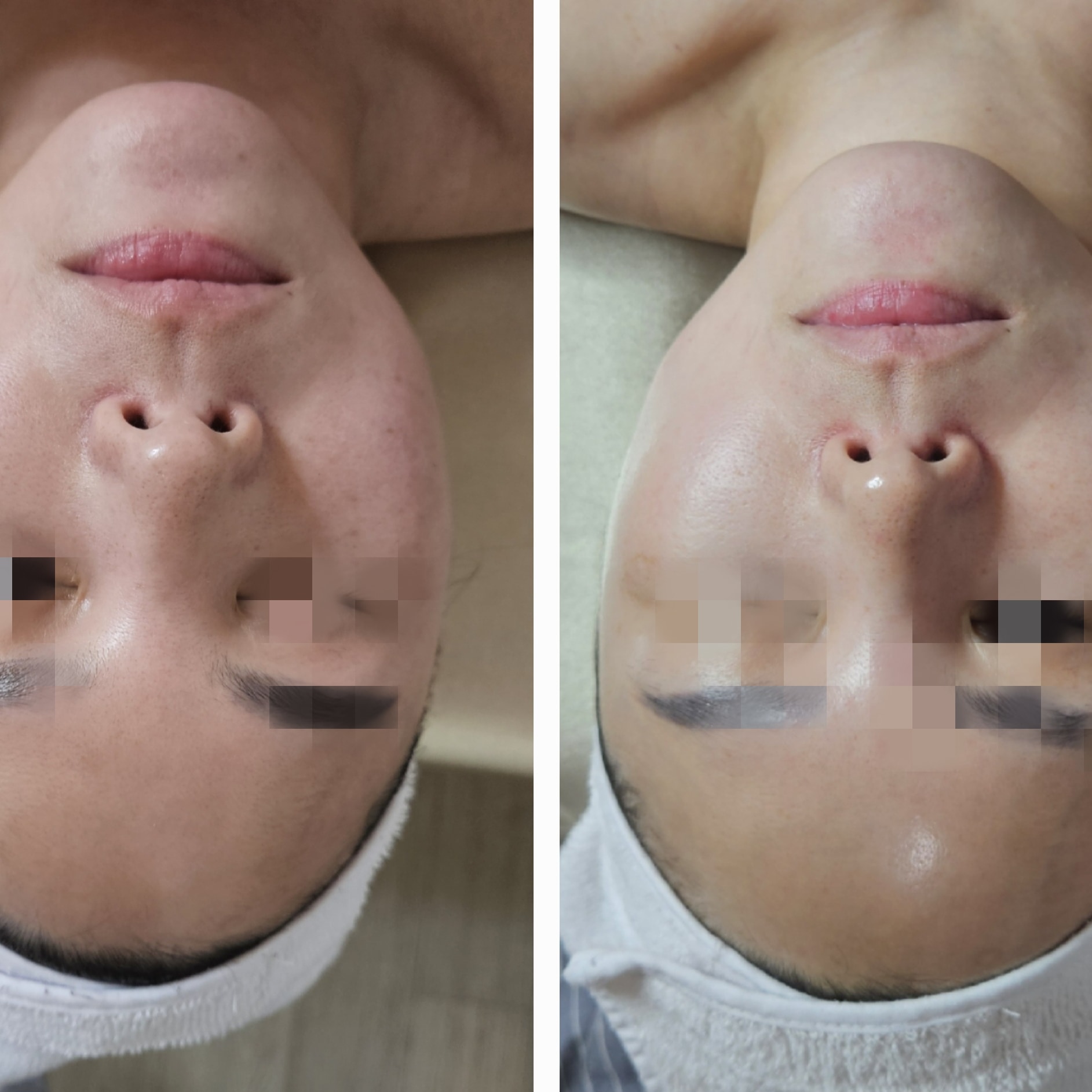 샘이나는 피부