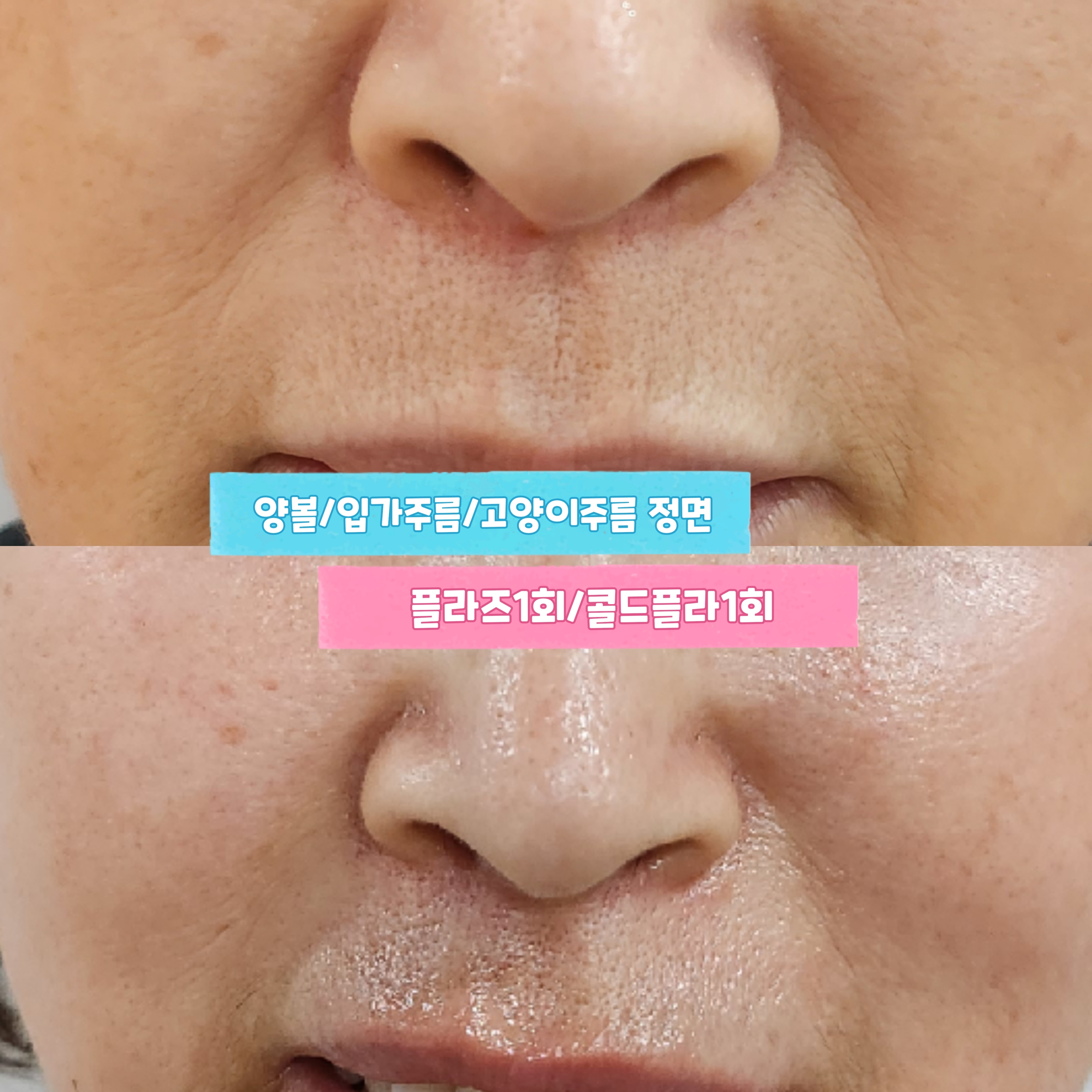 플라즈마블라스트 지아뷰티