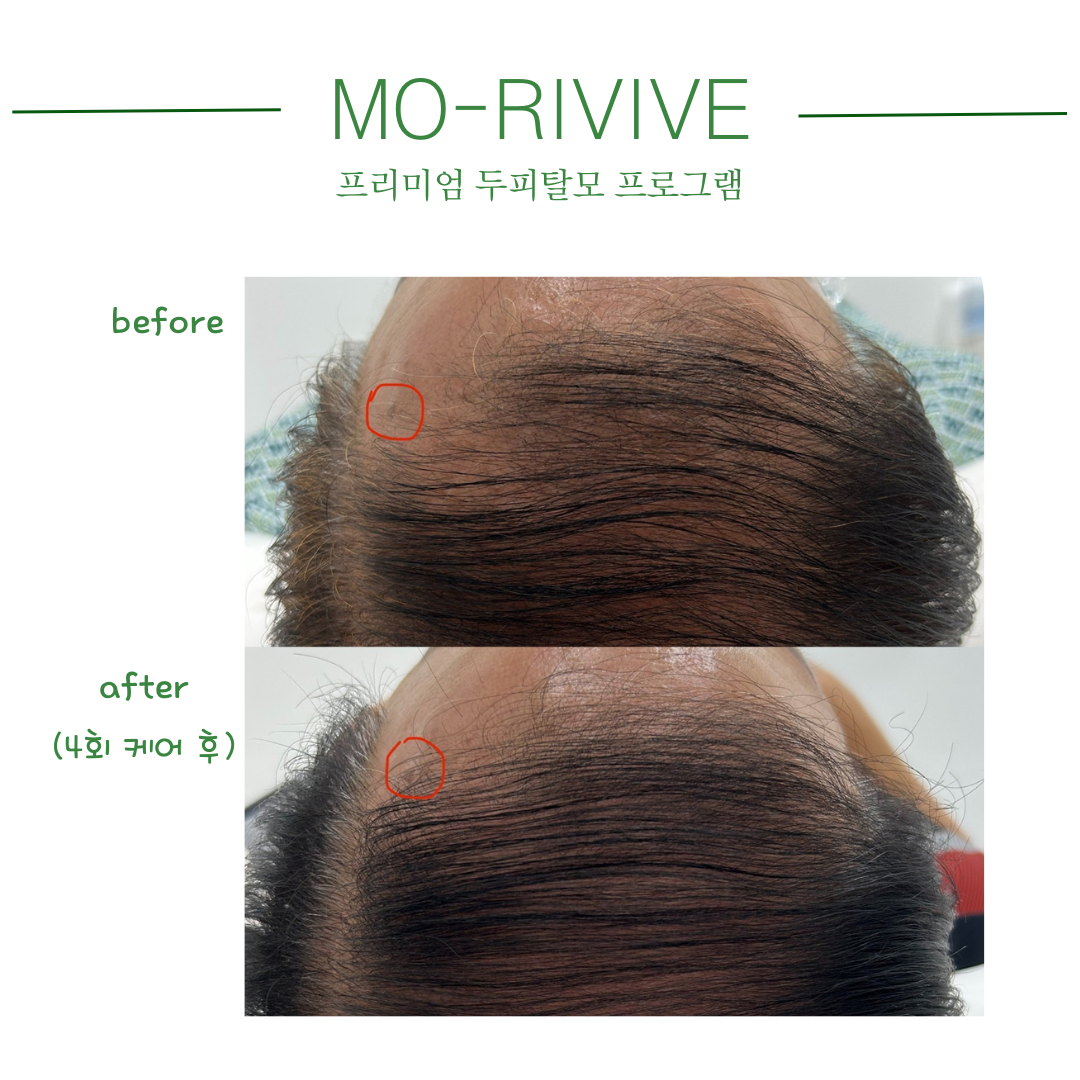 채움제이 가발 모발생장술 두피탈모관리