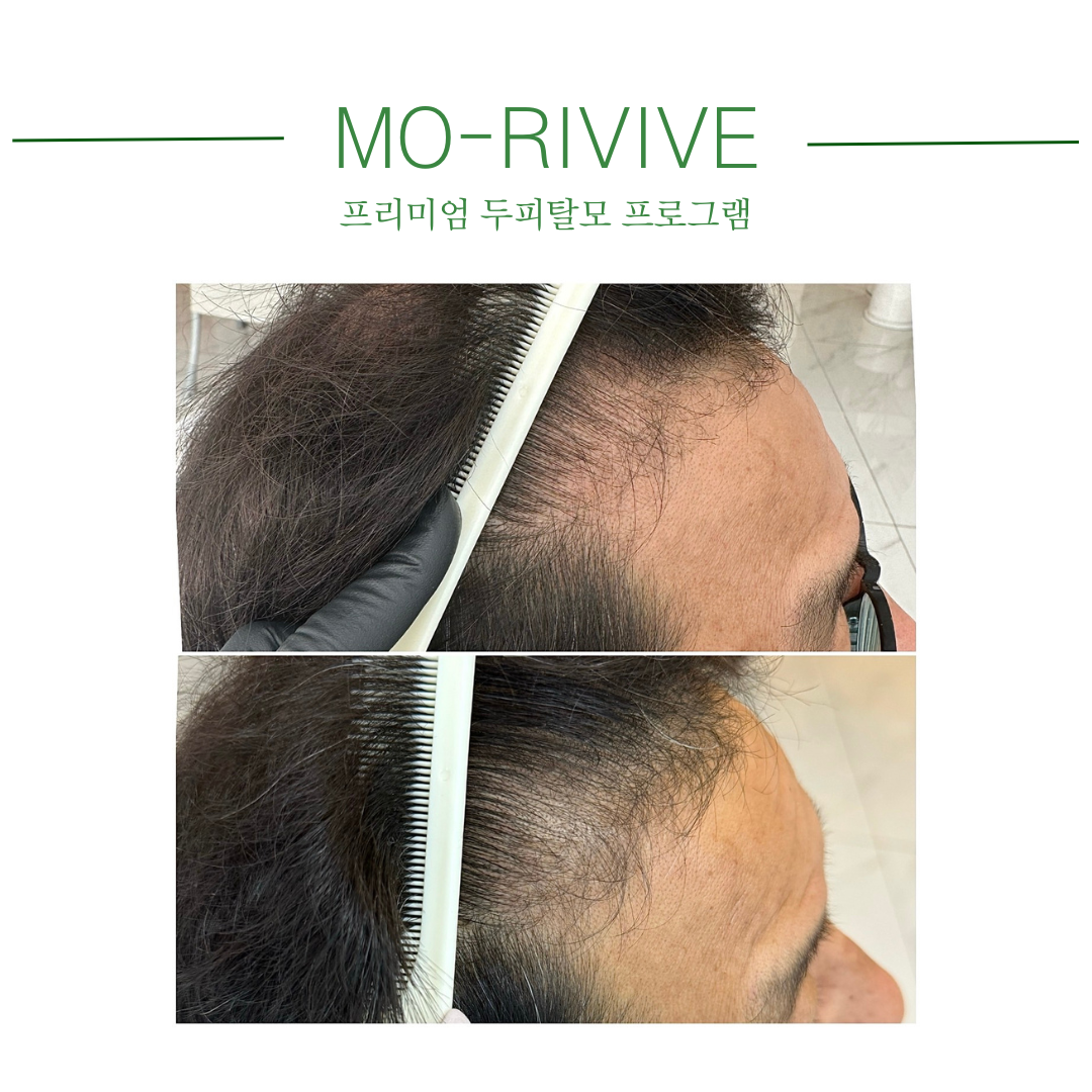 채움제이 가발 모발생장술 두피탈모관리