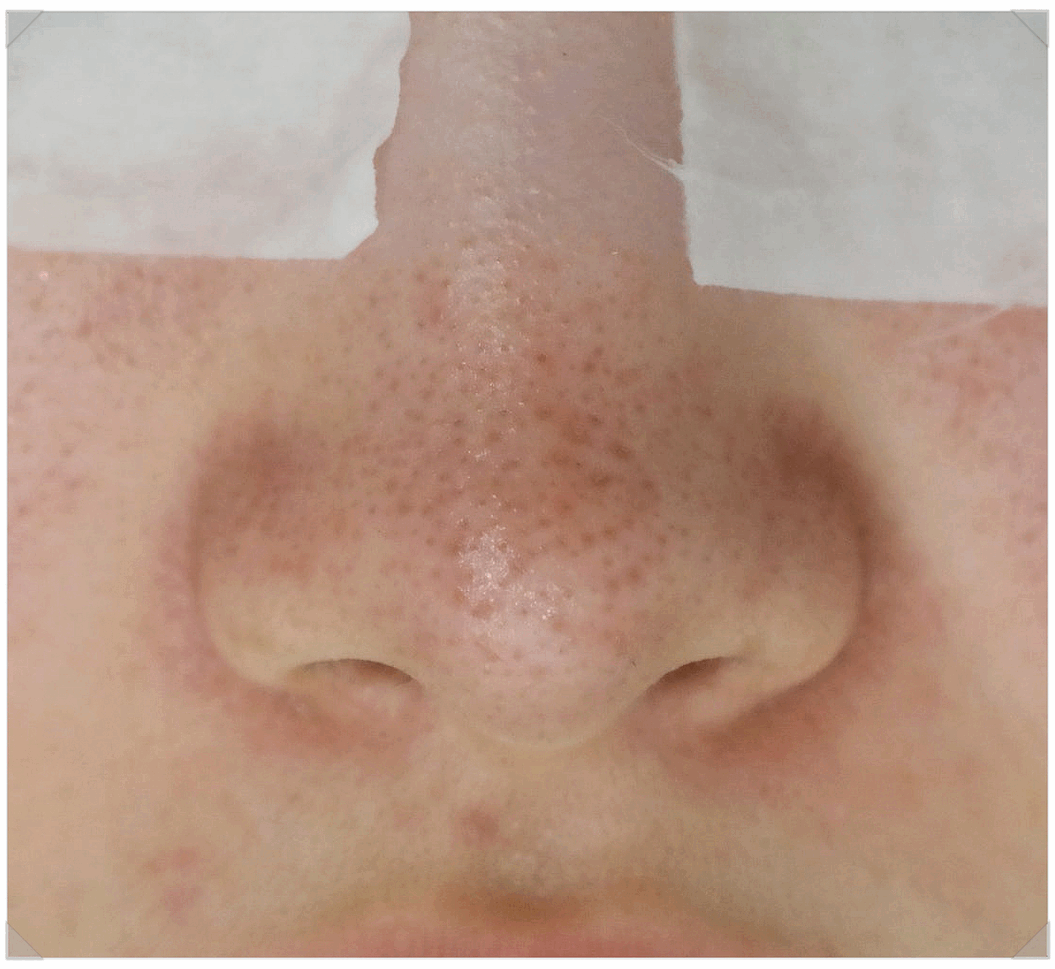 블랙헤드 코피다 대표 이미지