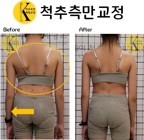 케이척추측만체형교정