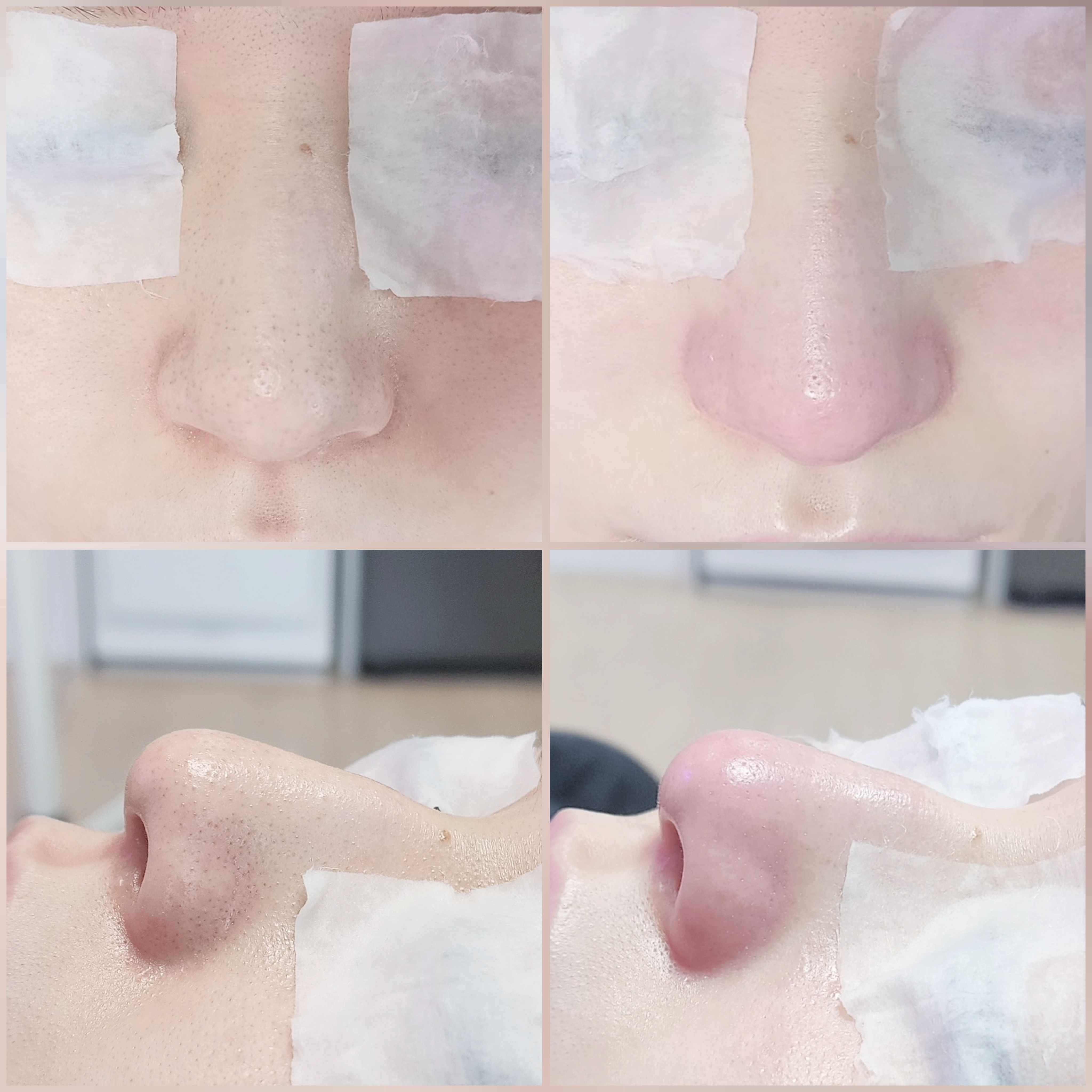 블랙헤드 코피다 대표 이미지