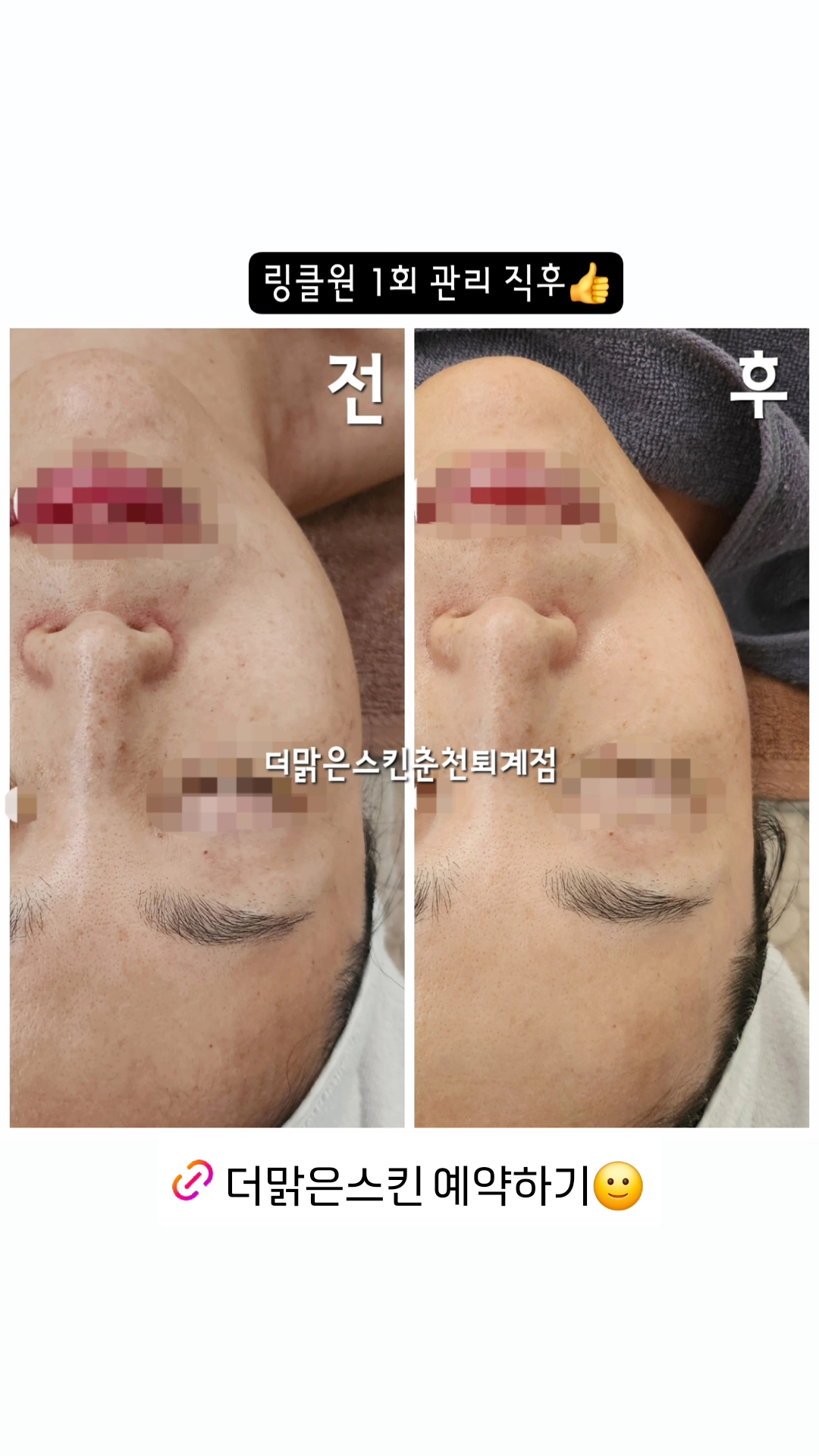 더맑은스킨 춘천퇴계점