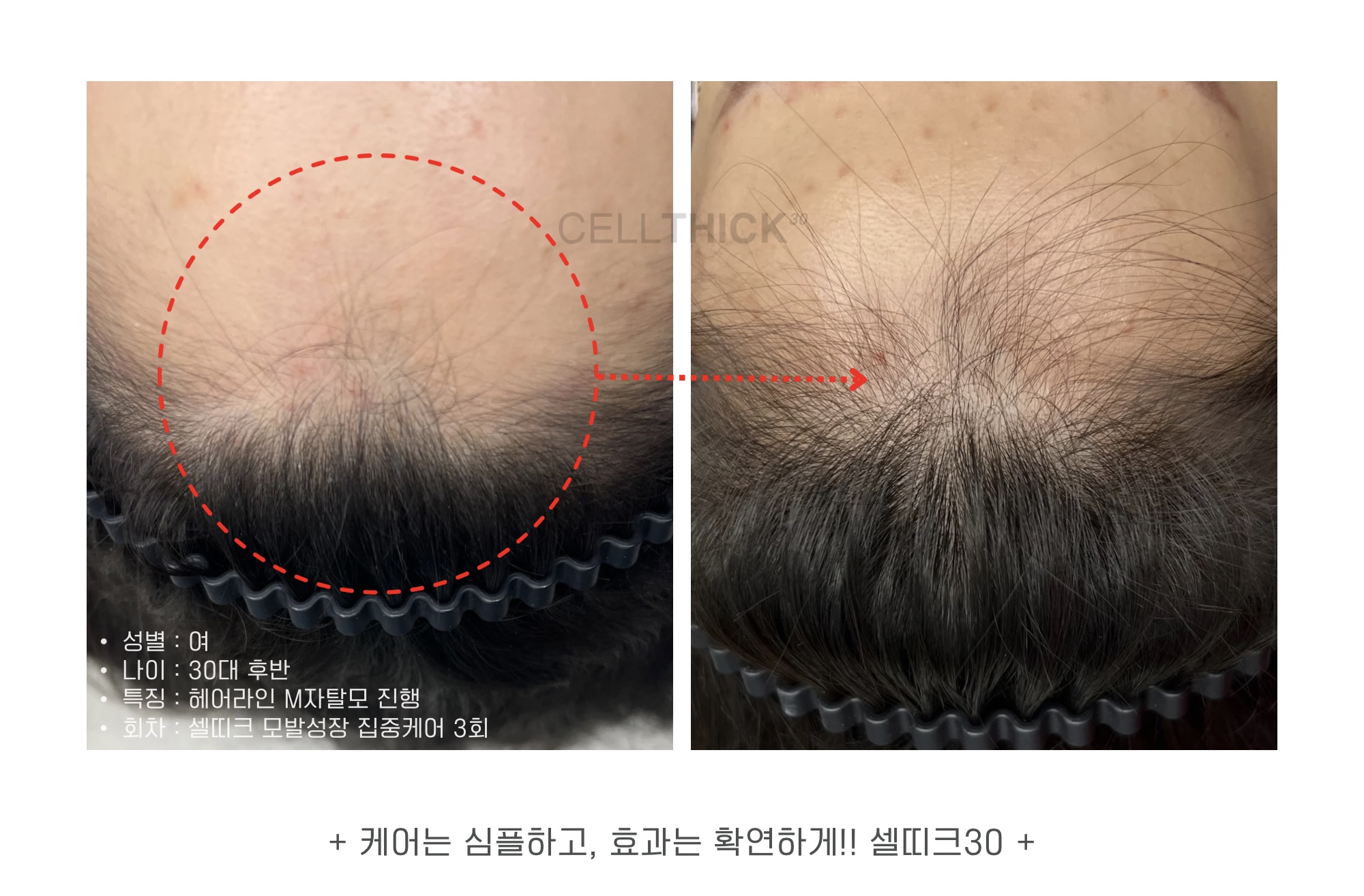 라온하제 두피 탈모케어 눈썹 속눈썹펌 천안본점