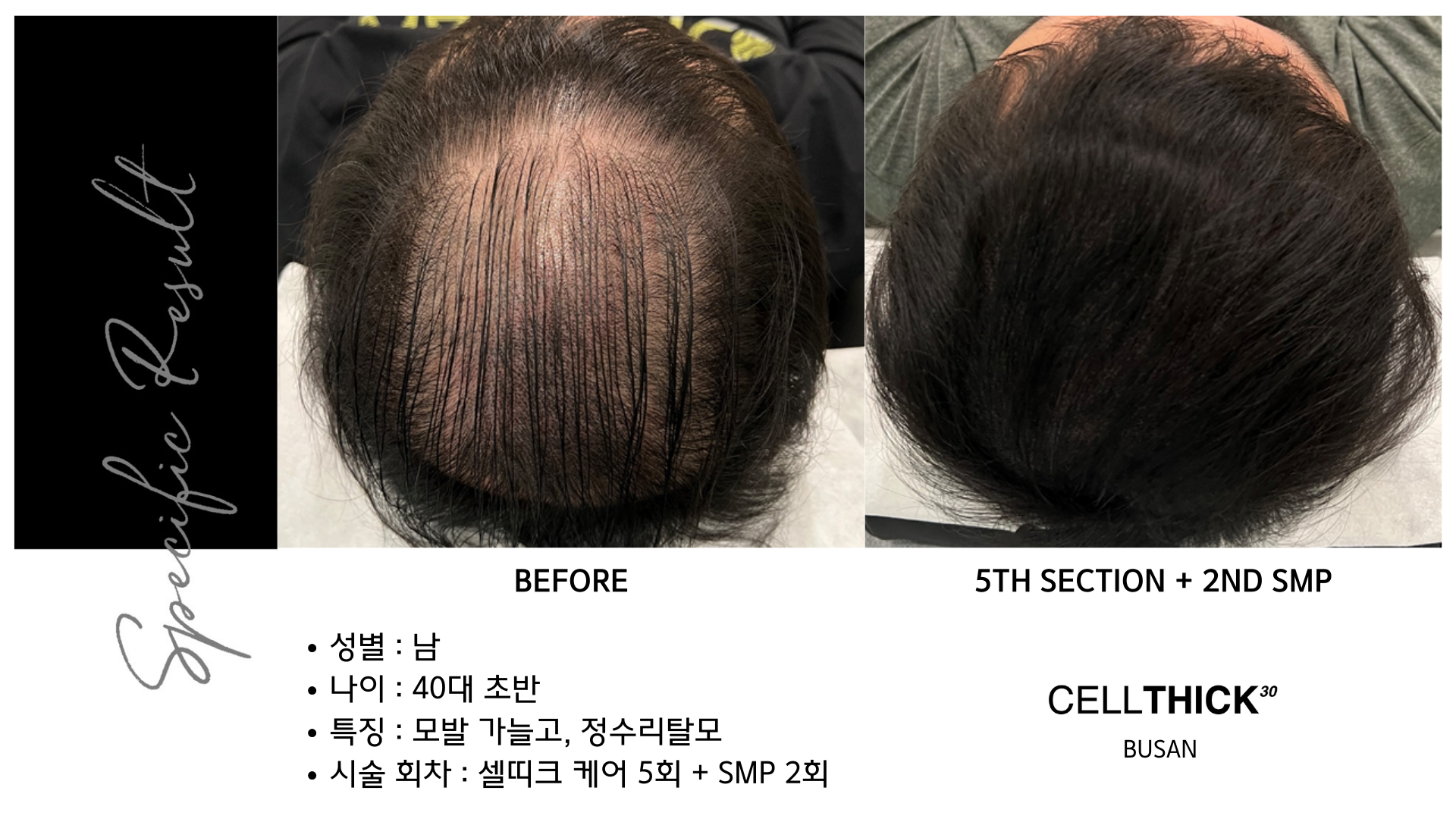 라온하제 두피 탈모케어 눈썹 속눈썹펌 천안본점