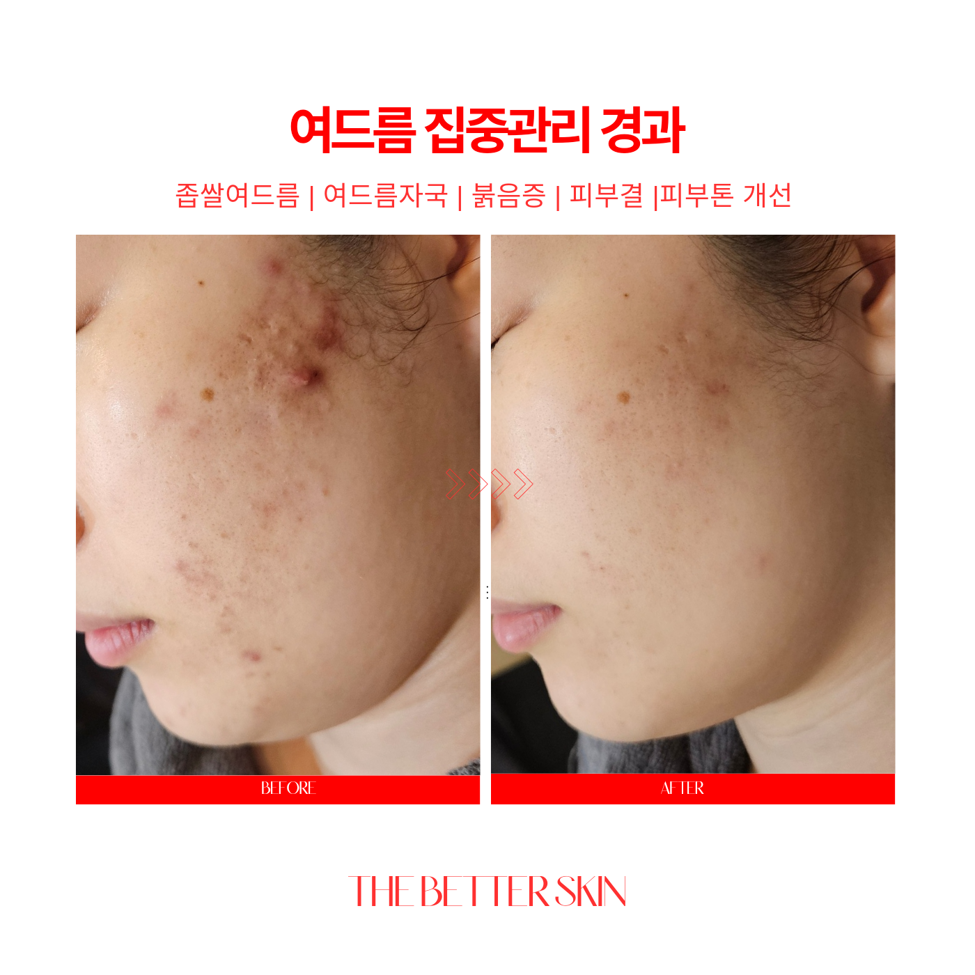 더좋은피부