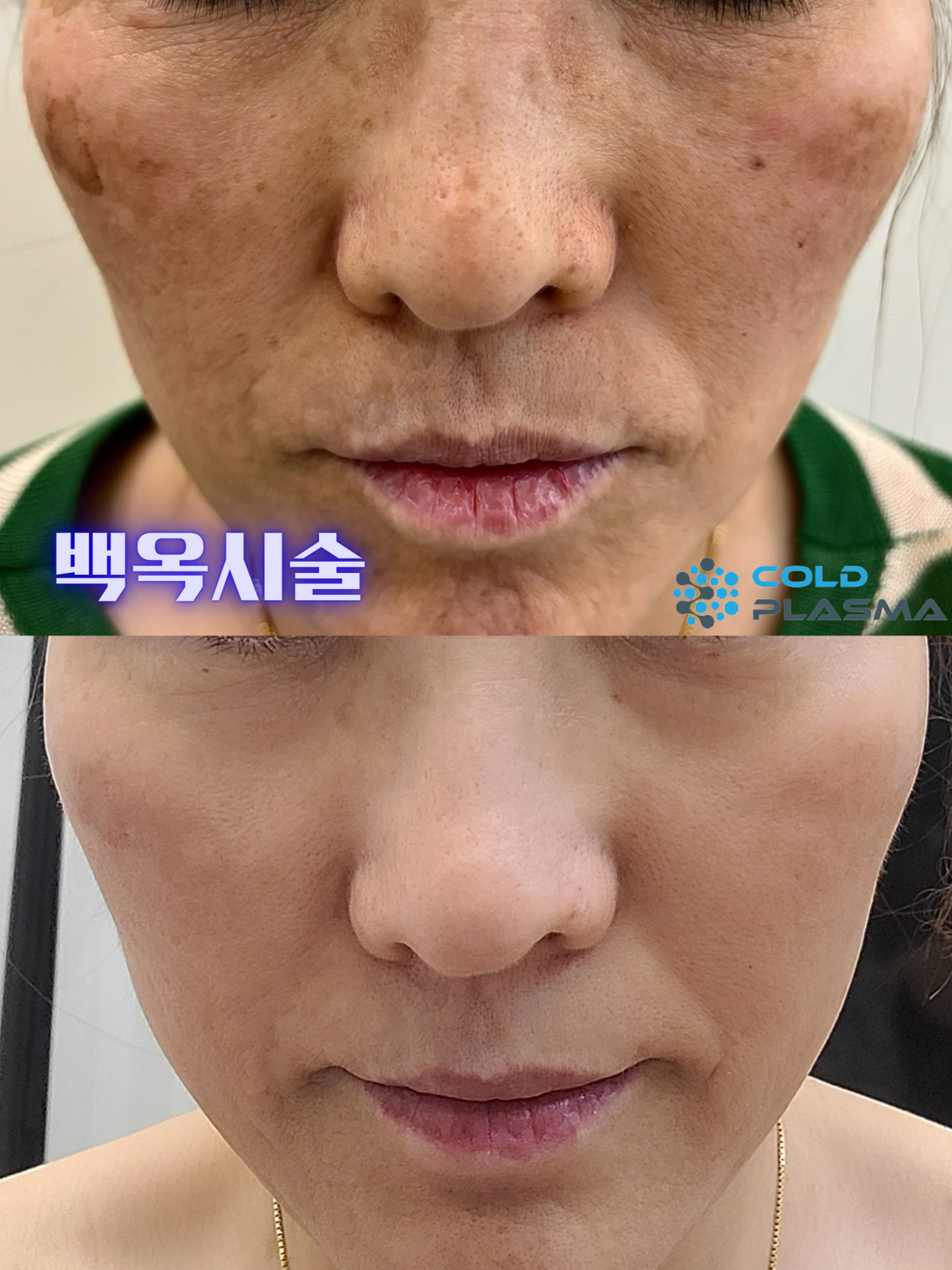 플라즈마헤베 울산본점