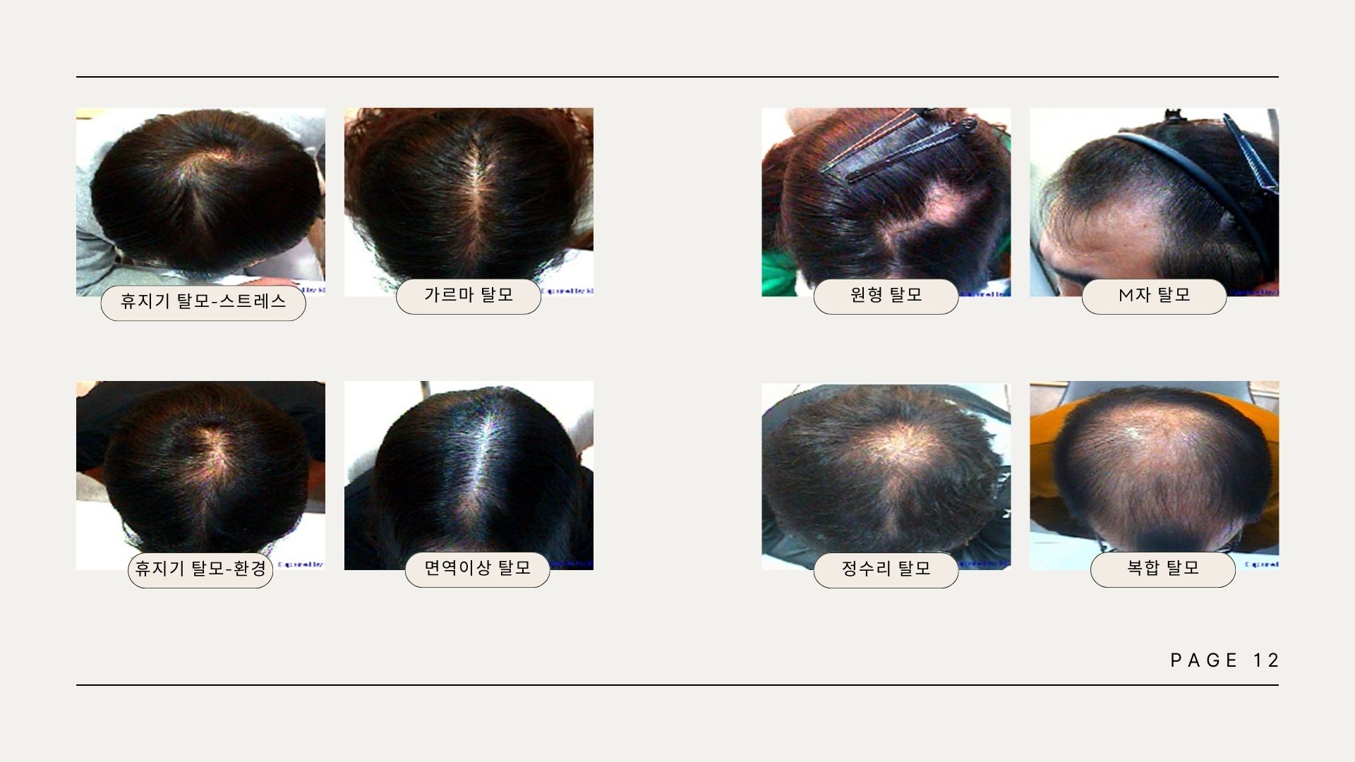 웰킨두피탈모센터 시흥배곧점