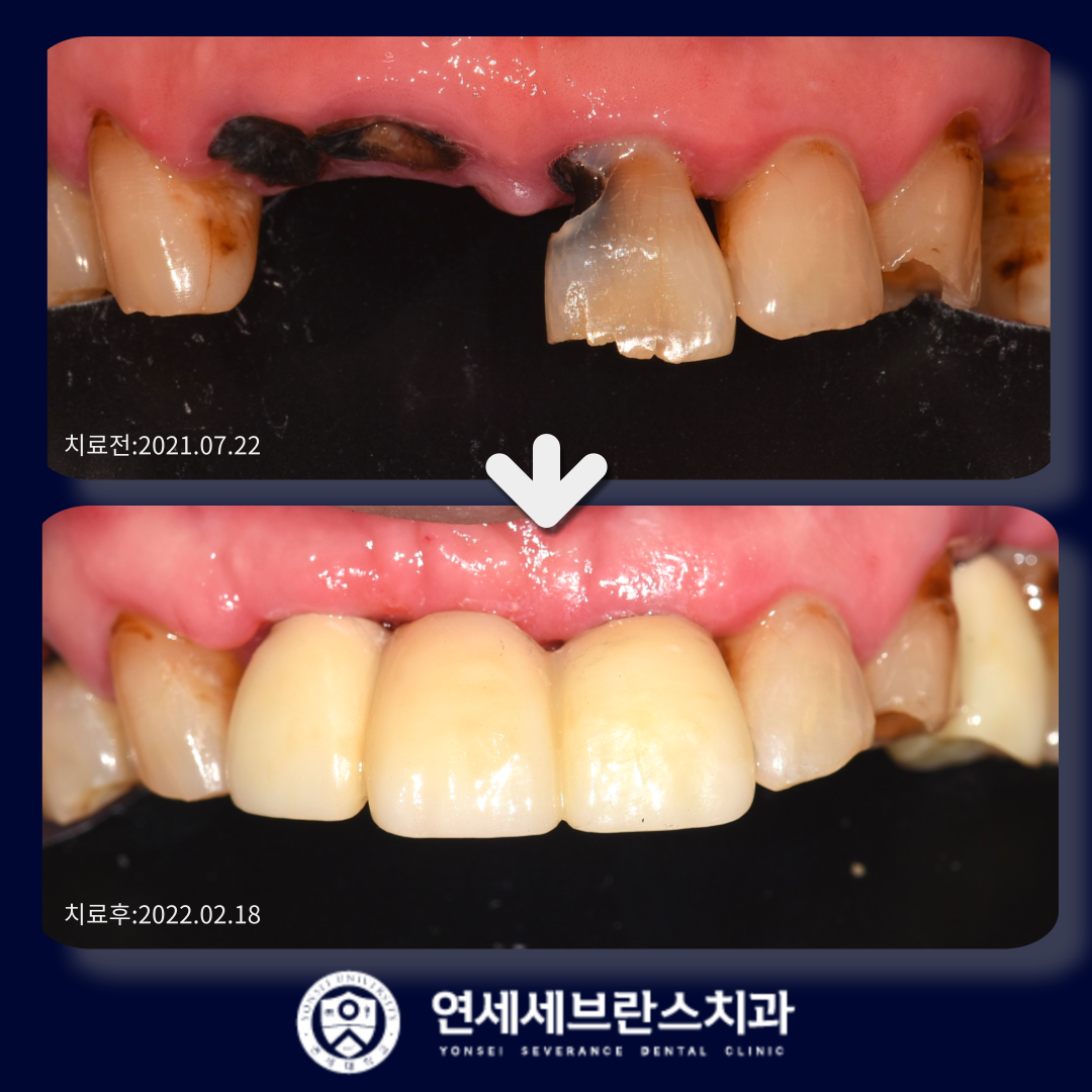 ์ฐ์ธ์ธ๋ธ๋์ค์น๊ณผ์์ ๋ํ ์ด๋ฏธ์ง