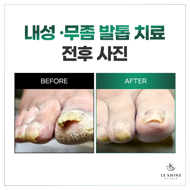 르샤인의원 문제성발톱클리닉 대표 이미지