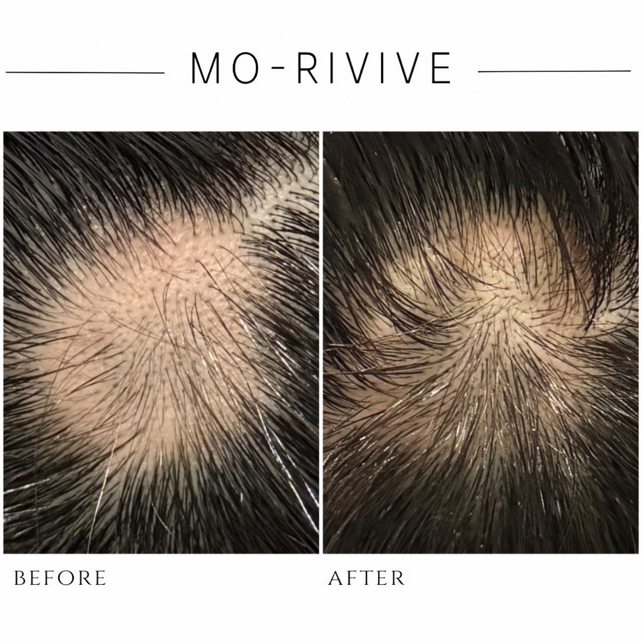 도라랩 두피탈모 모리바이브 대표 이미지