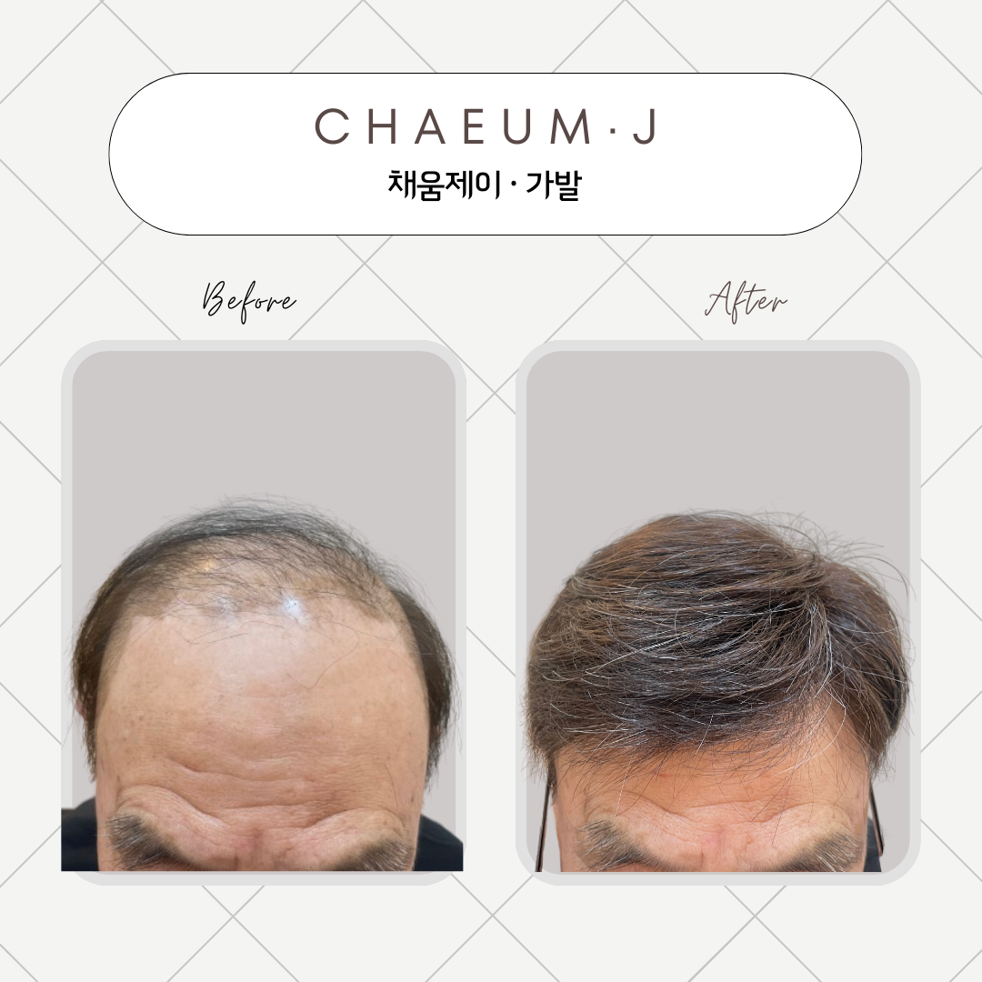 채움제이 가발 모발생장술 두피탈모관리