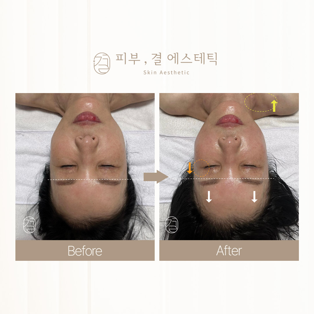 피부,결 에스테틱