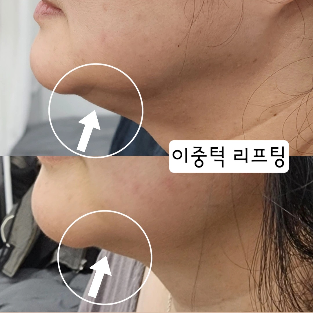 뷰티쏠대곡점 플라즈마블라스트
