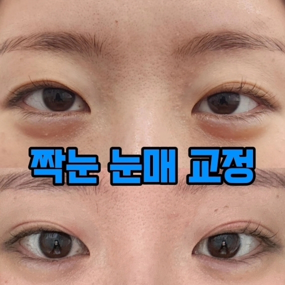 뷰티쏠대곡점 플라즈마블라스트