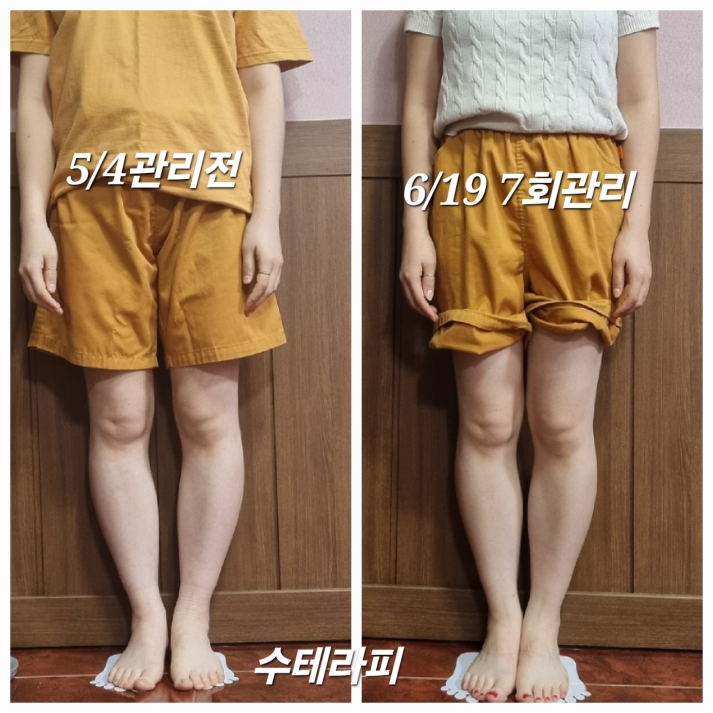 수테라피 대표 이미지