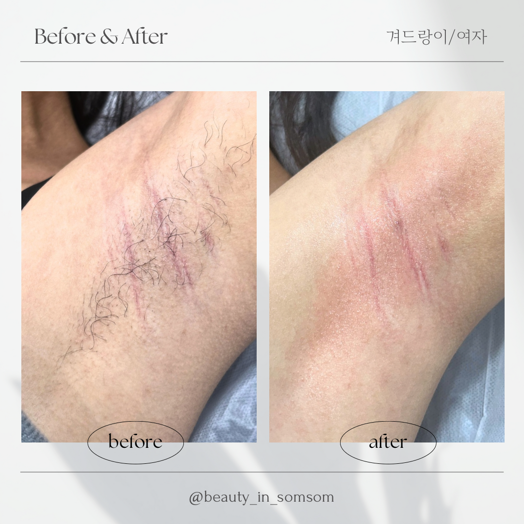 뷰티인솜솜 슈가링 달동점