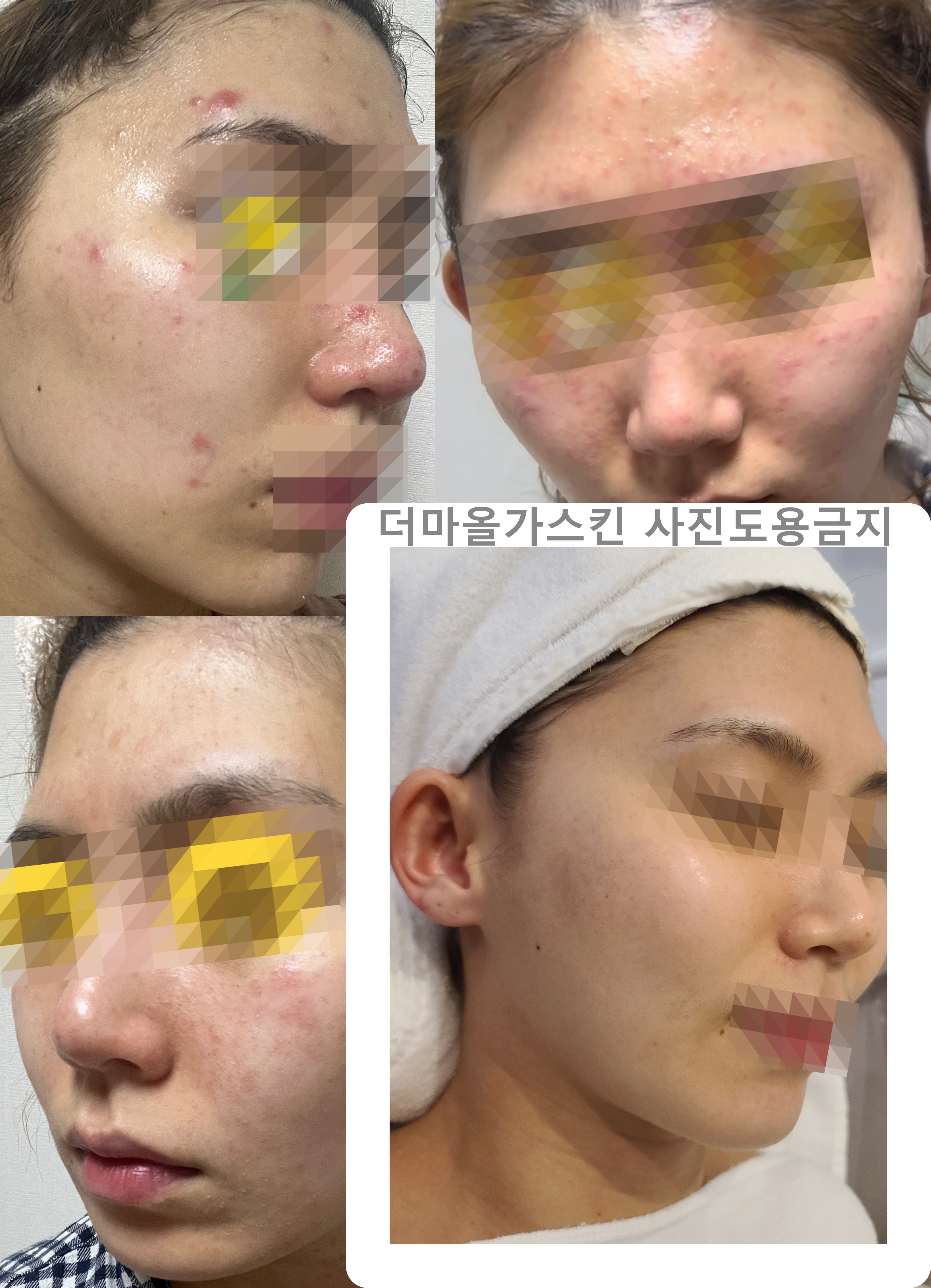 더마올가스킨