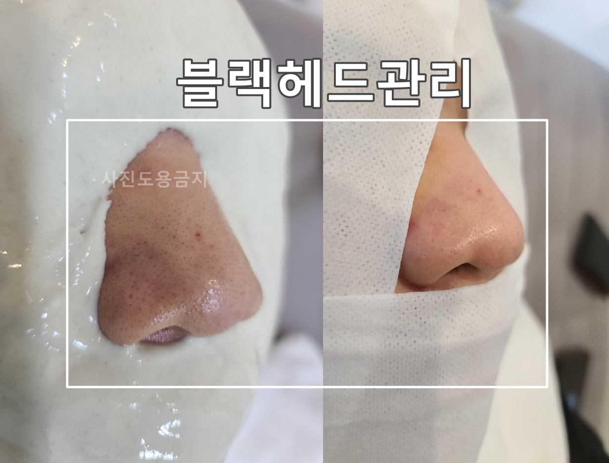 더마올가스킨