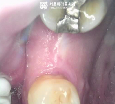 미라클