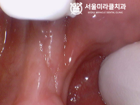 미라클