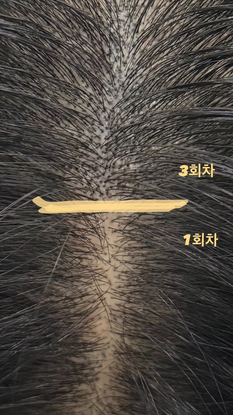 다린스칼프