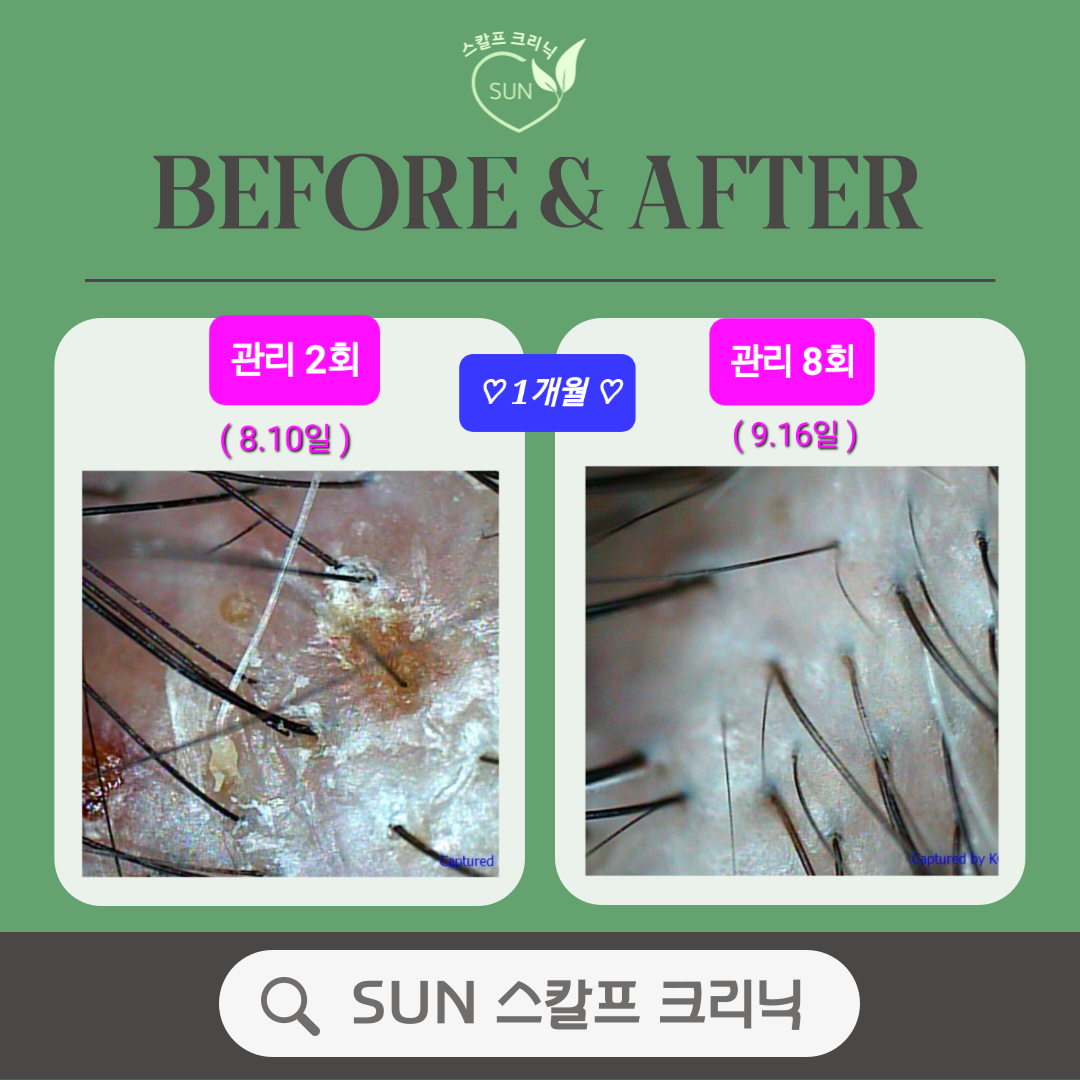 SUN 스칼프 크리닉 대표 이미지