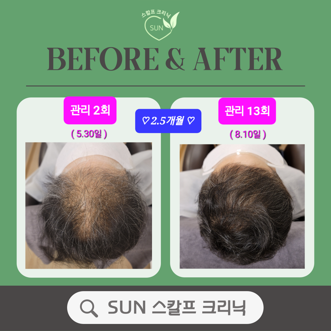 SUN 스칼프 크리닉 대표 이미지