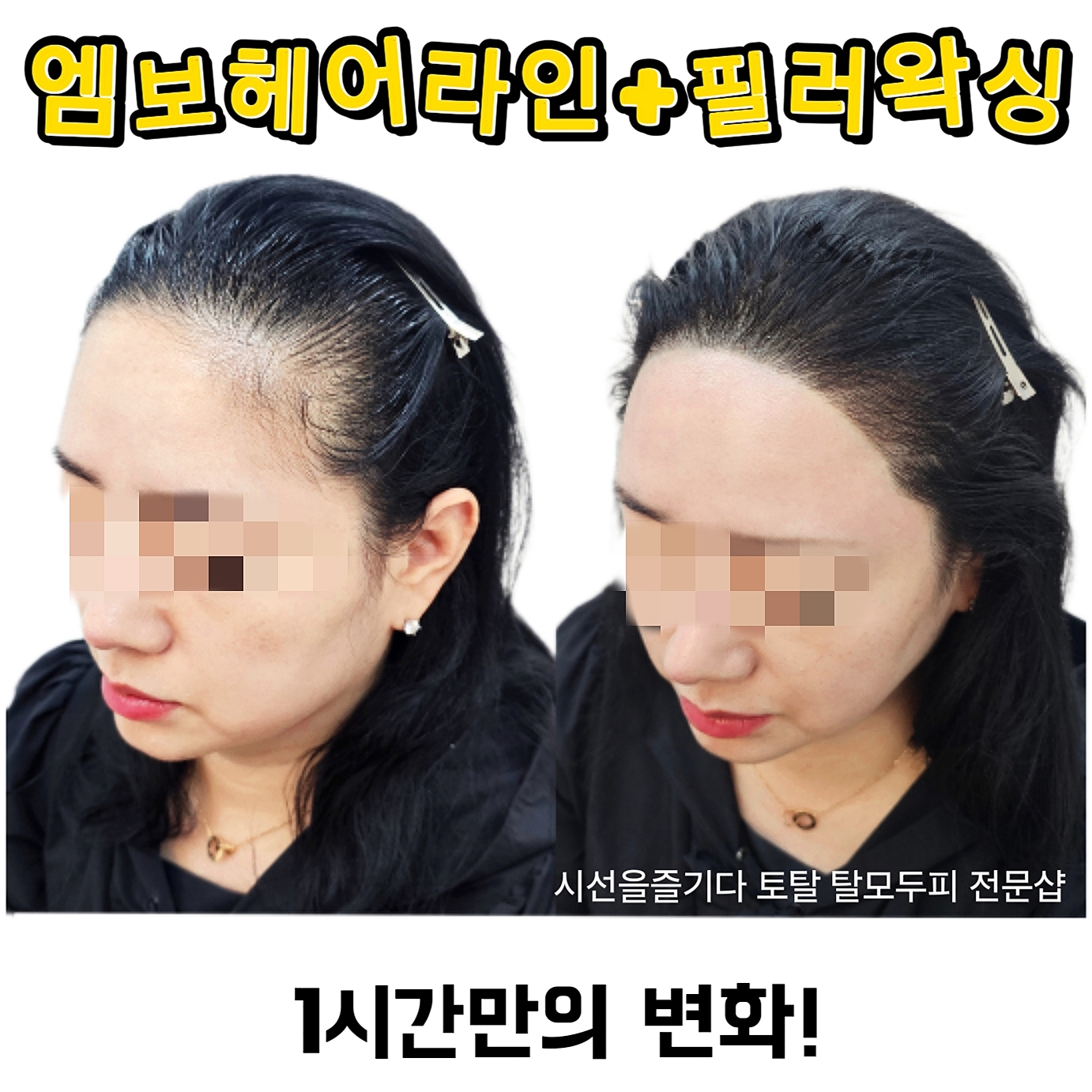 시선을즐기다 탈모 두피 커버 헤어라인 전문 부산점