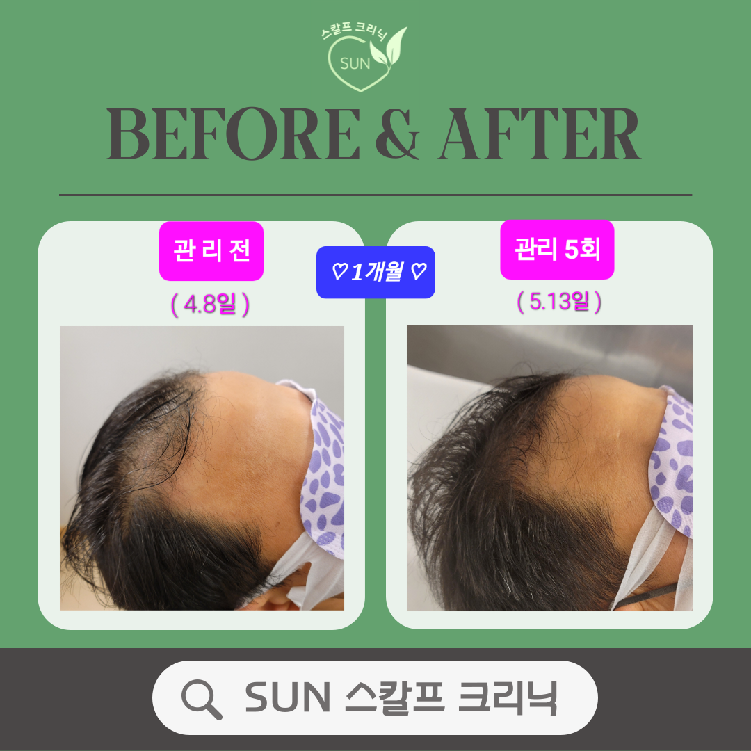 SUN 스칼프 크리닉 대표 이미지