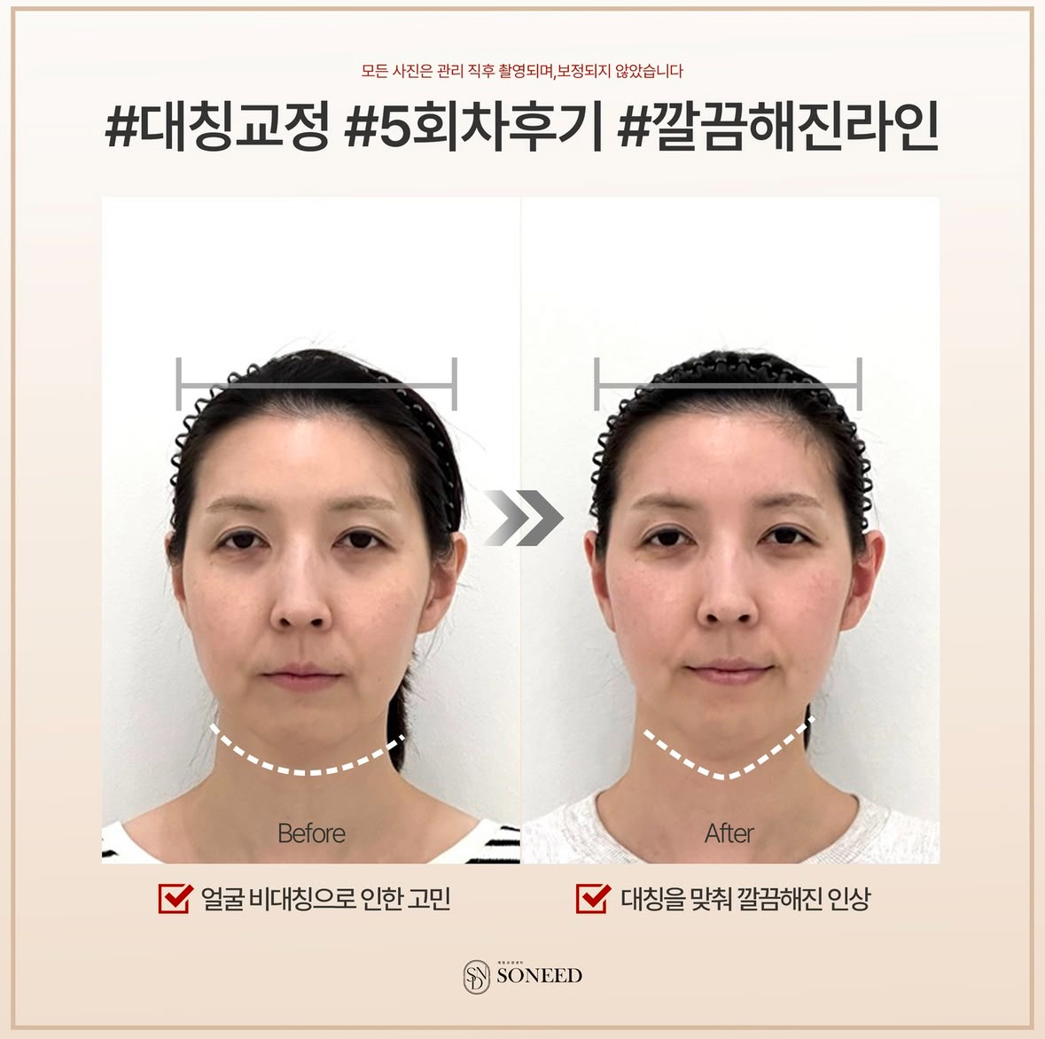 소니드 얼굴윤곽 대치도곡점 대표 이미지