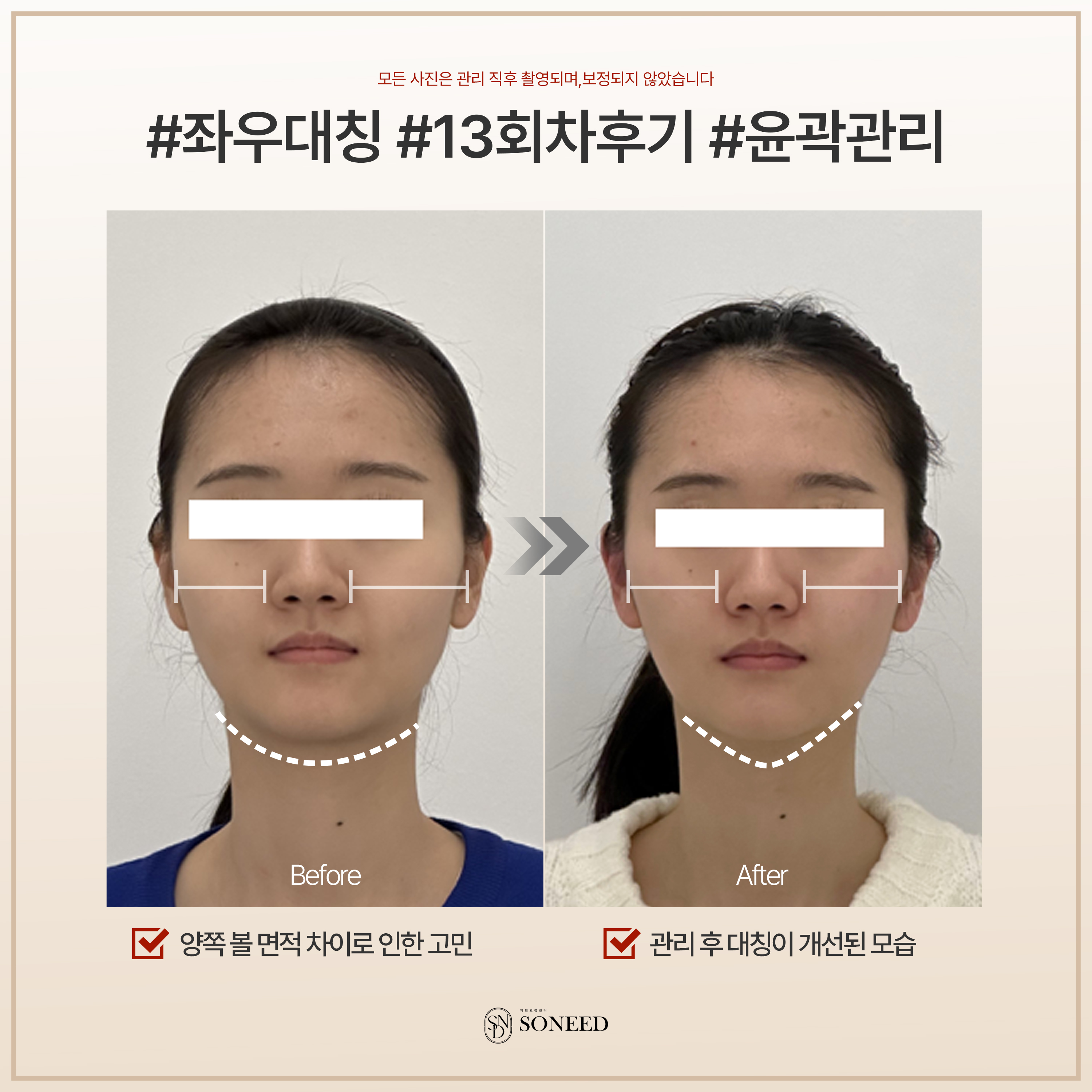 소니드 얼굴윤곽 대치도곡점 대표 이미지