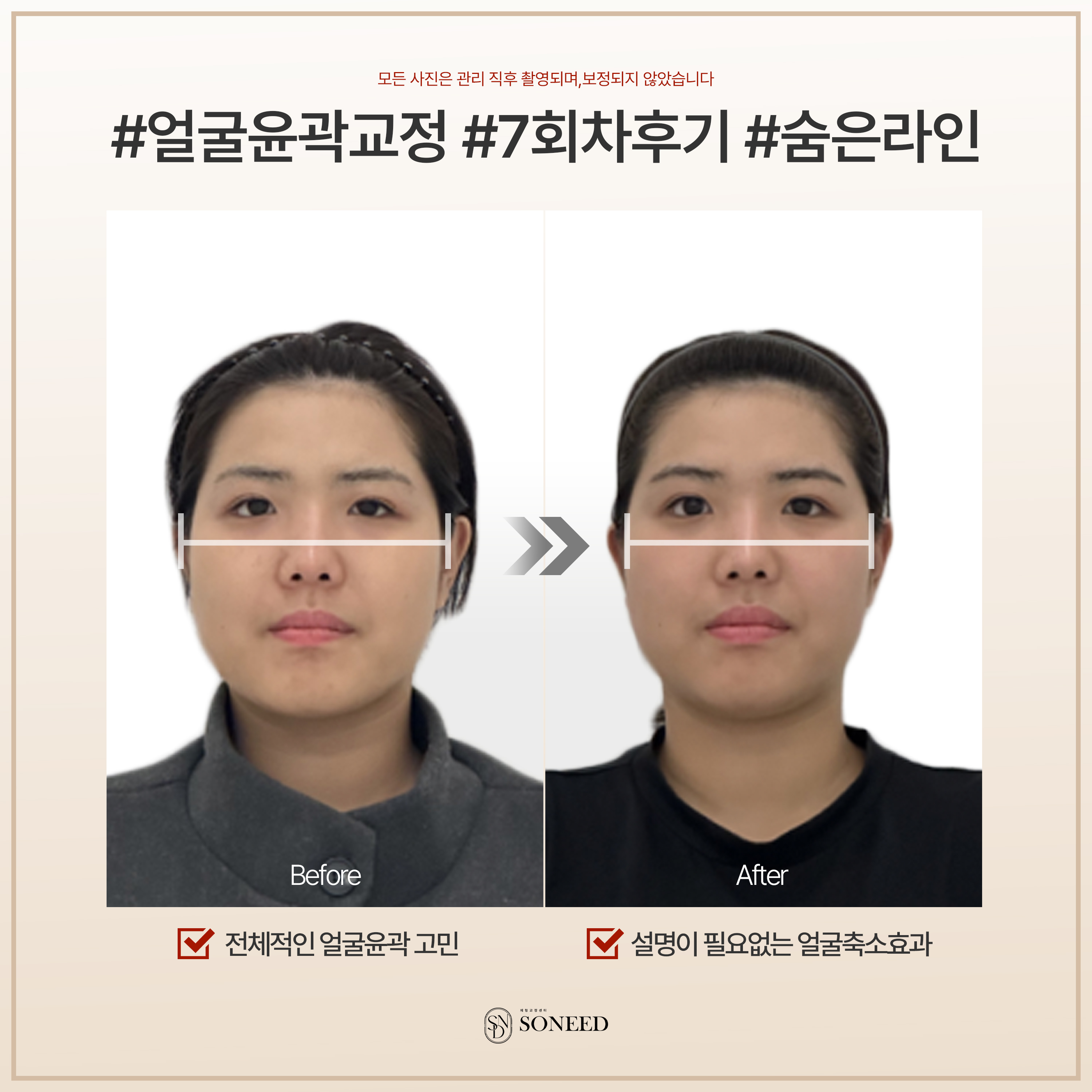 소니드 얼굴윤곽 대표 이미지