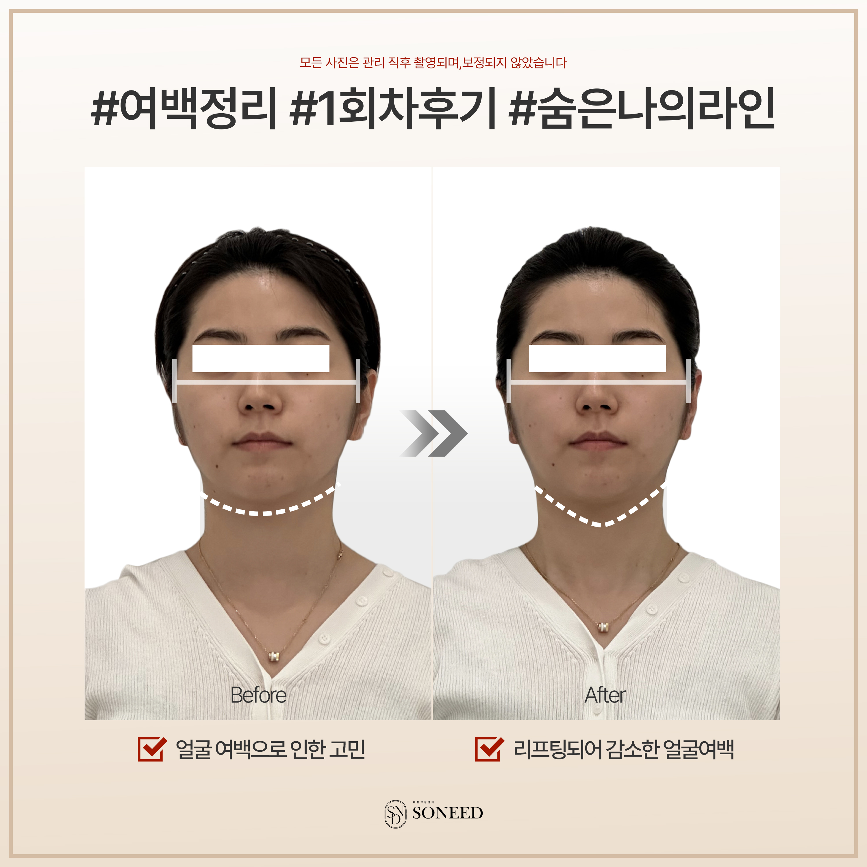 소니드 얼굴윤곽 대치도곡점 대표 이미지
