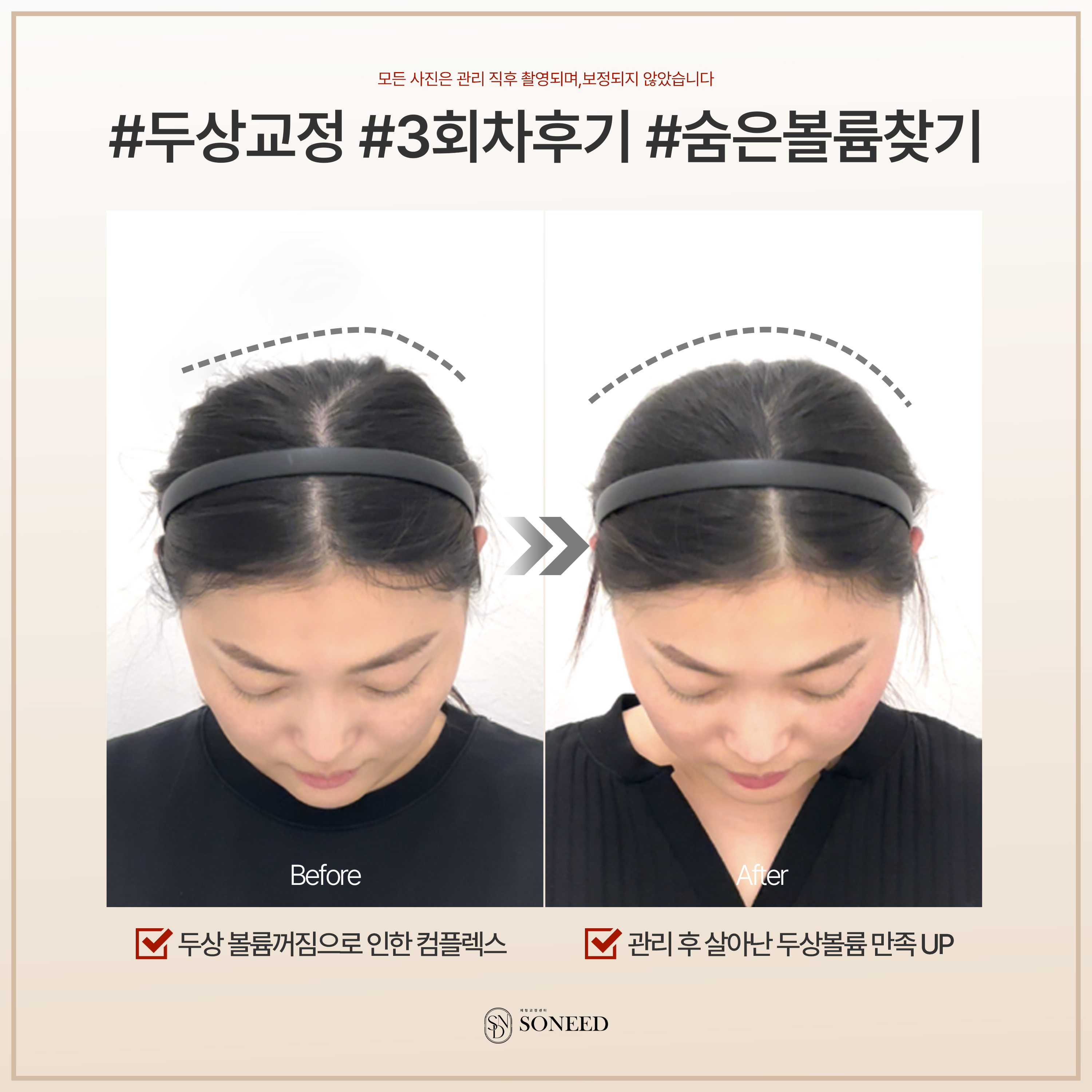 소니드 얼굴윤곽 대치도곡점 대표 이미지
