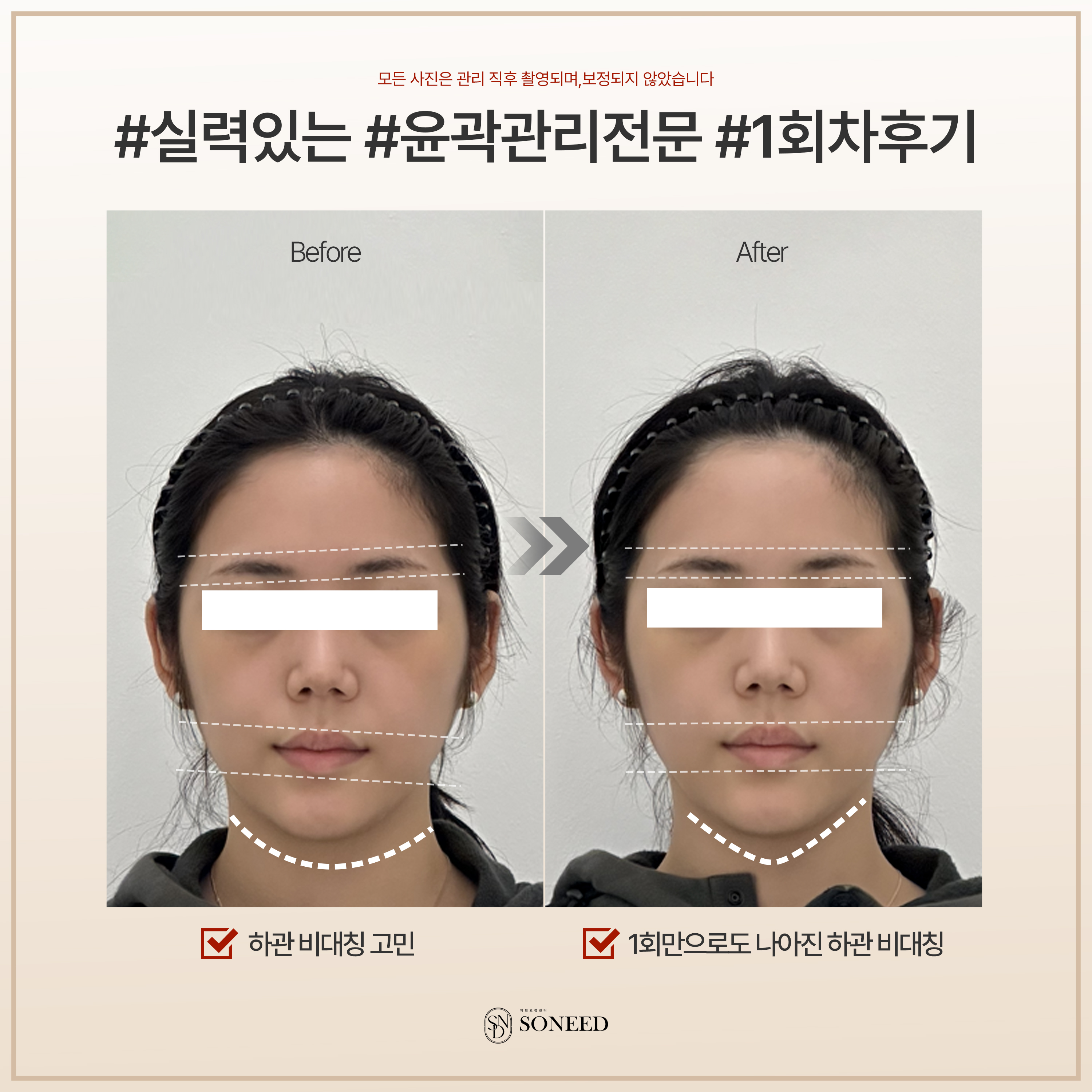 소니드얼굴윤곽 수원광교점