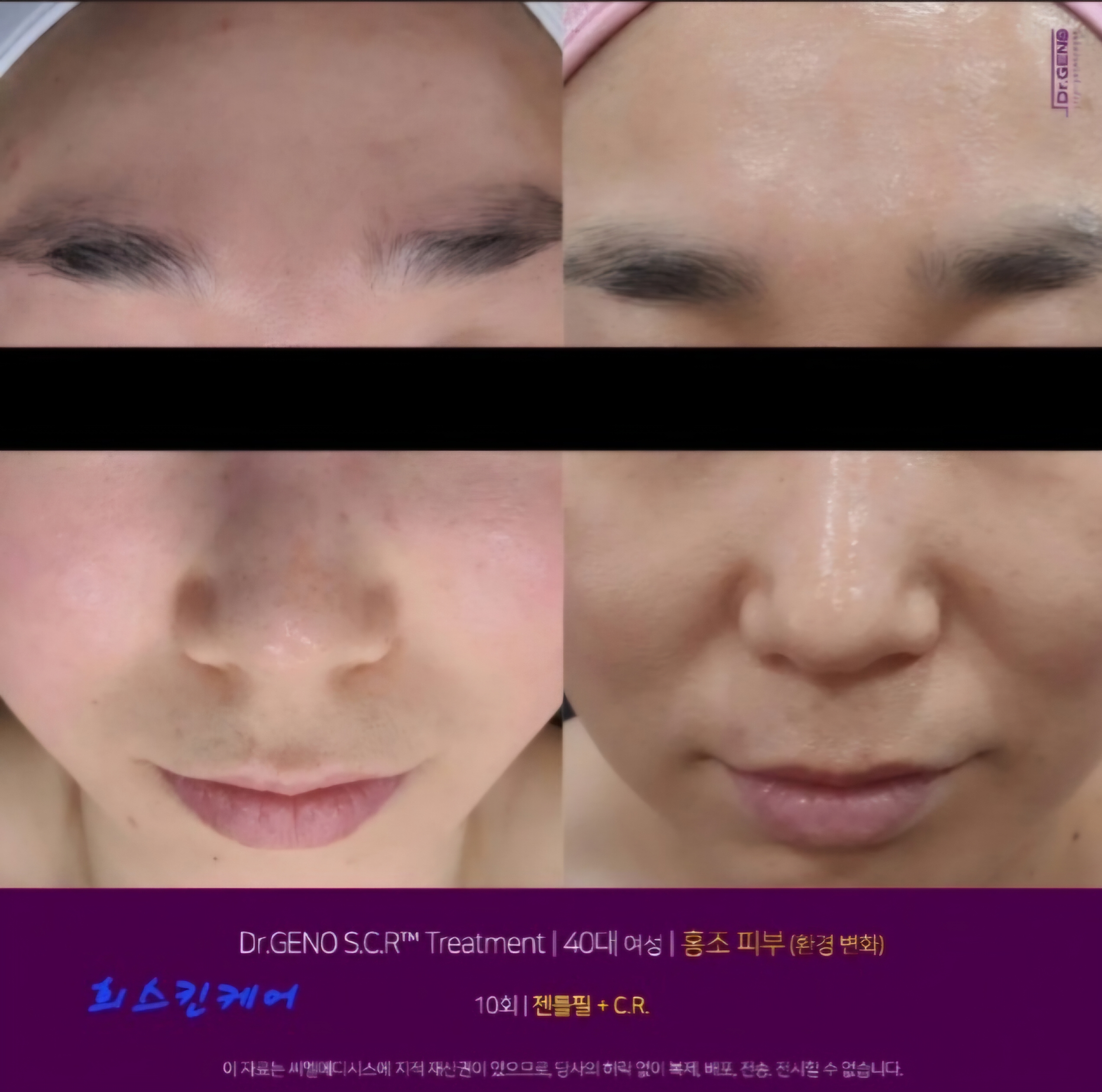 희 : 스킨케어