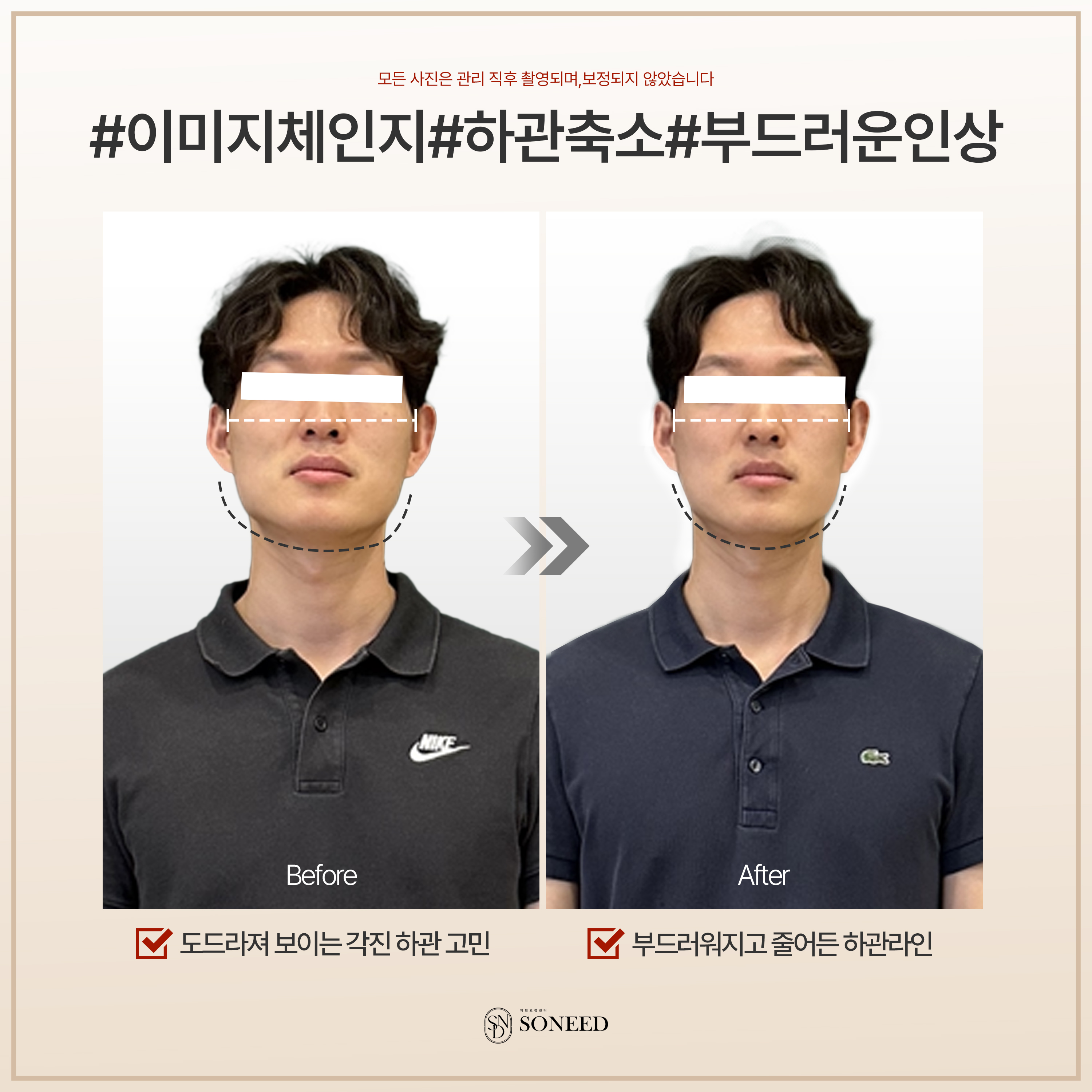 소니드 얼굴윤곽 대치도곡점 대표 이미지