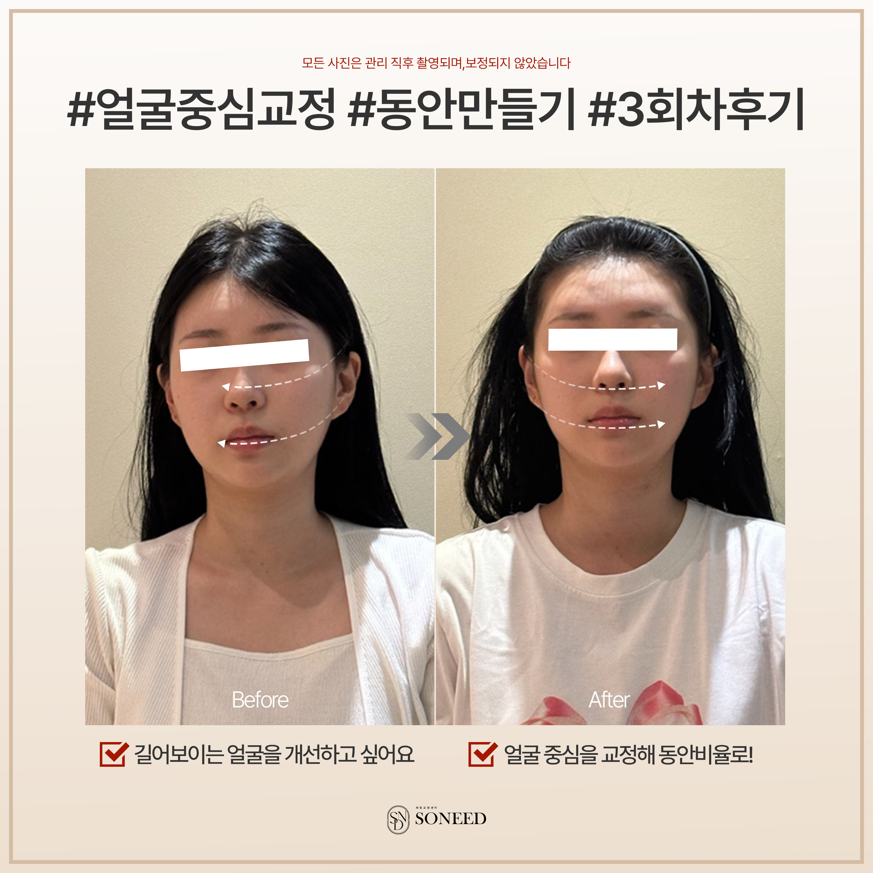소니드 얼굴윤곽 대치도곡점 대표 이미지