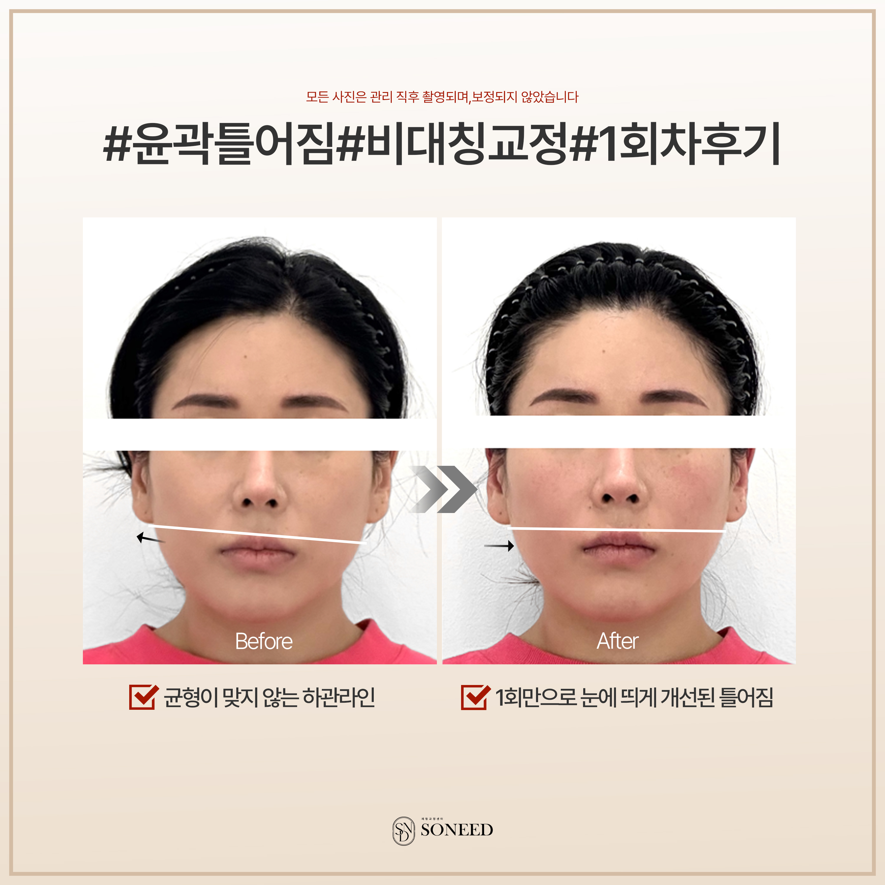 소니드얼굴윤곽 수원광교점 대표 이미지