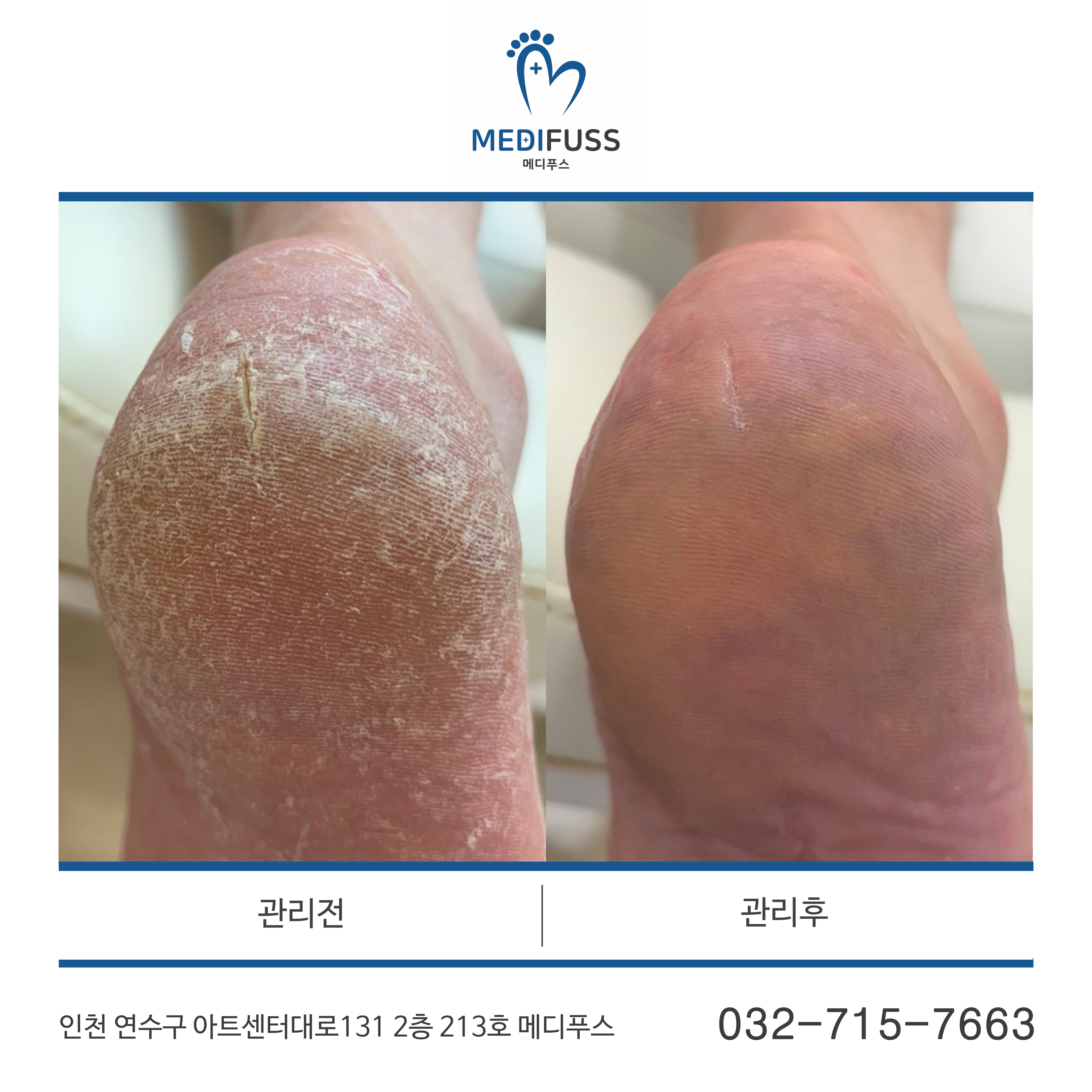 문제성발관리센터 메디푸스 내성발톱 무좀 각질 문제성발톱