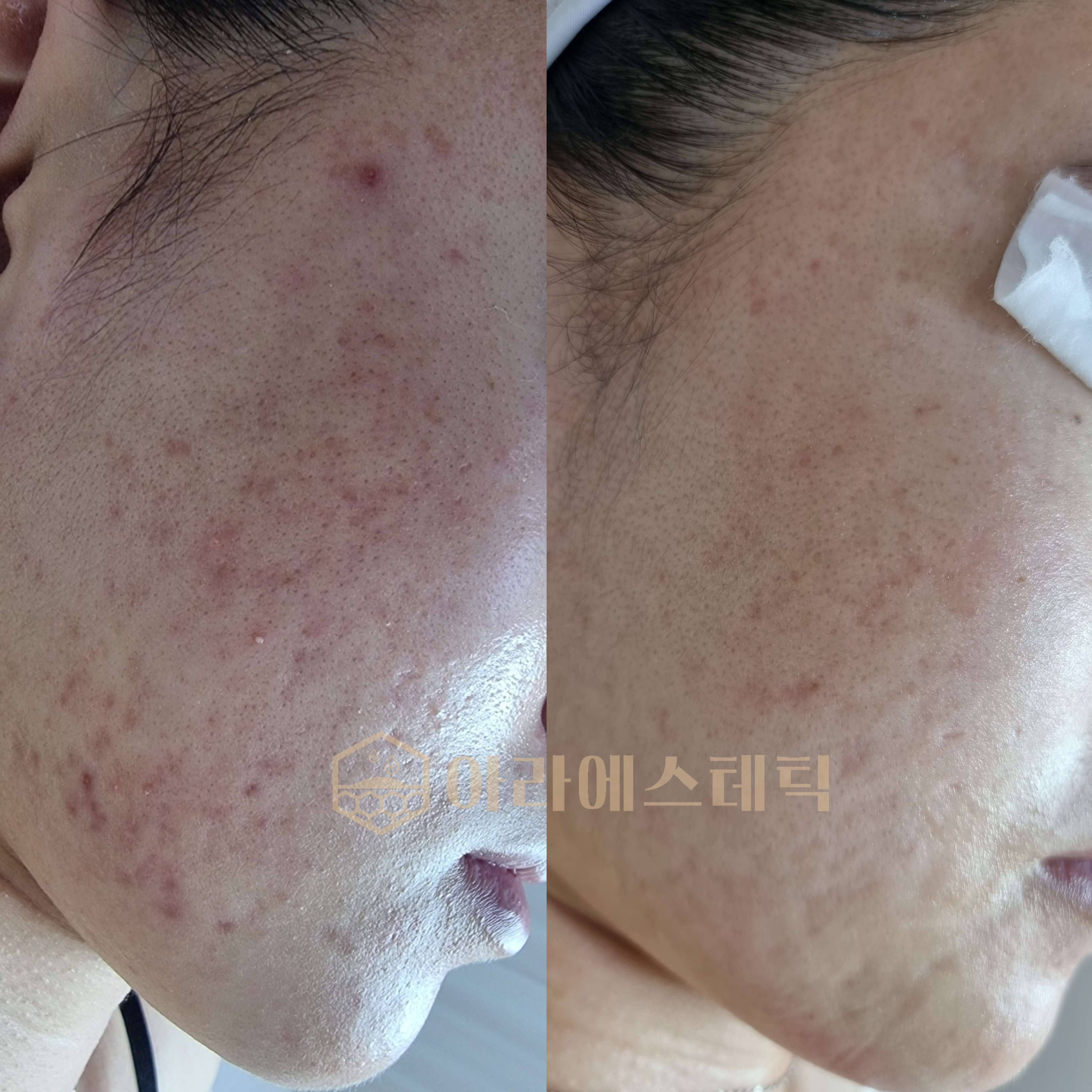 아라에스테틱 임상