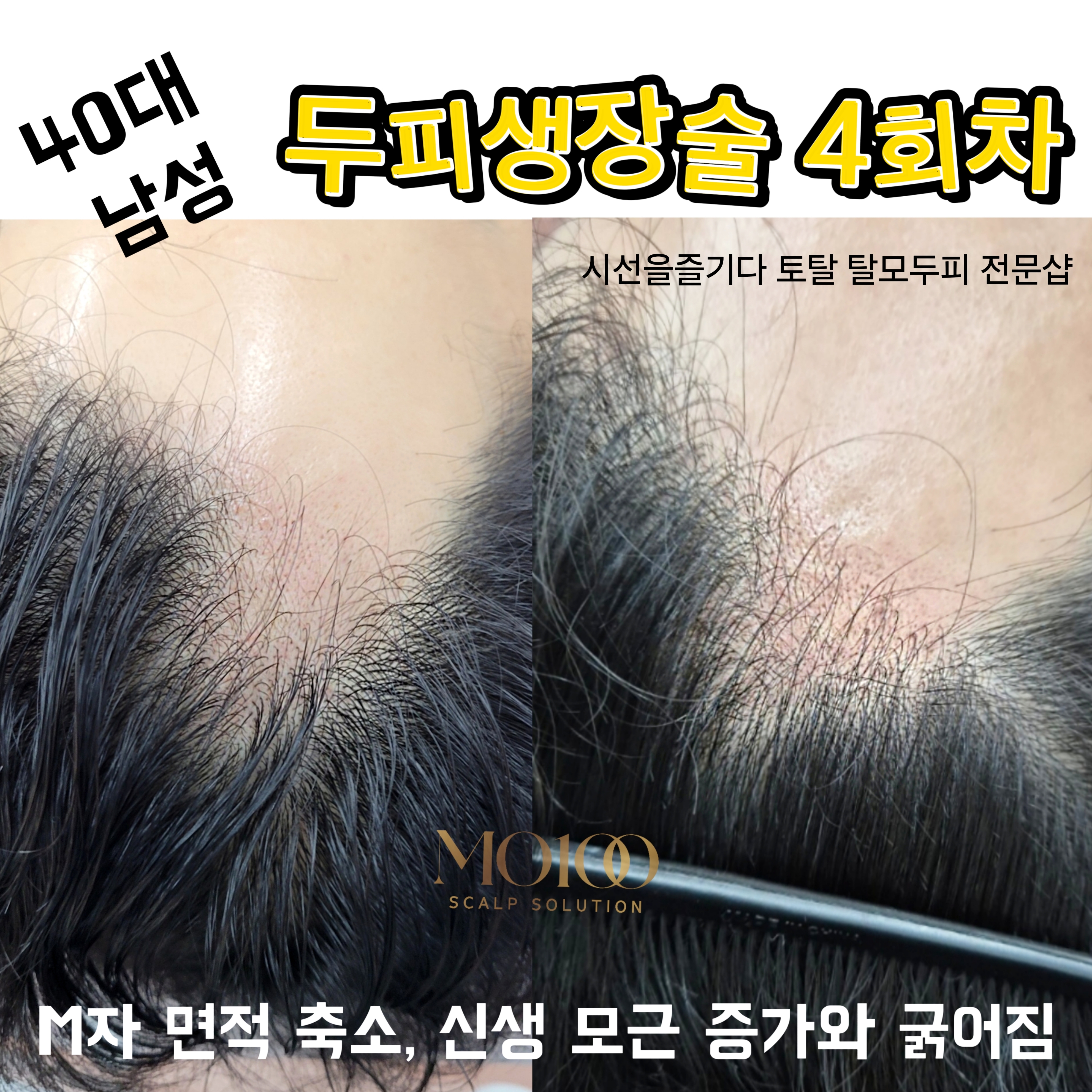 시선을즐기다 토탈 탈모 두피커버 전문샵