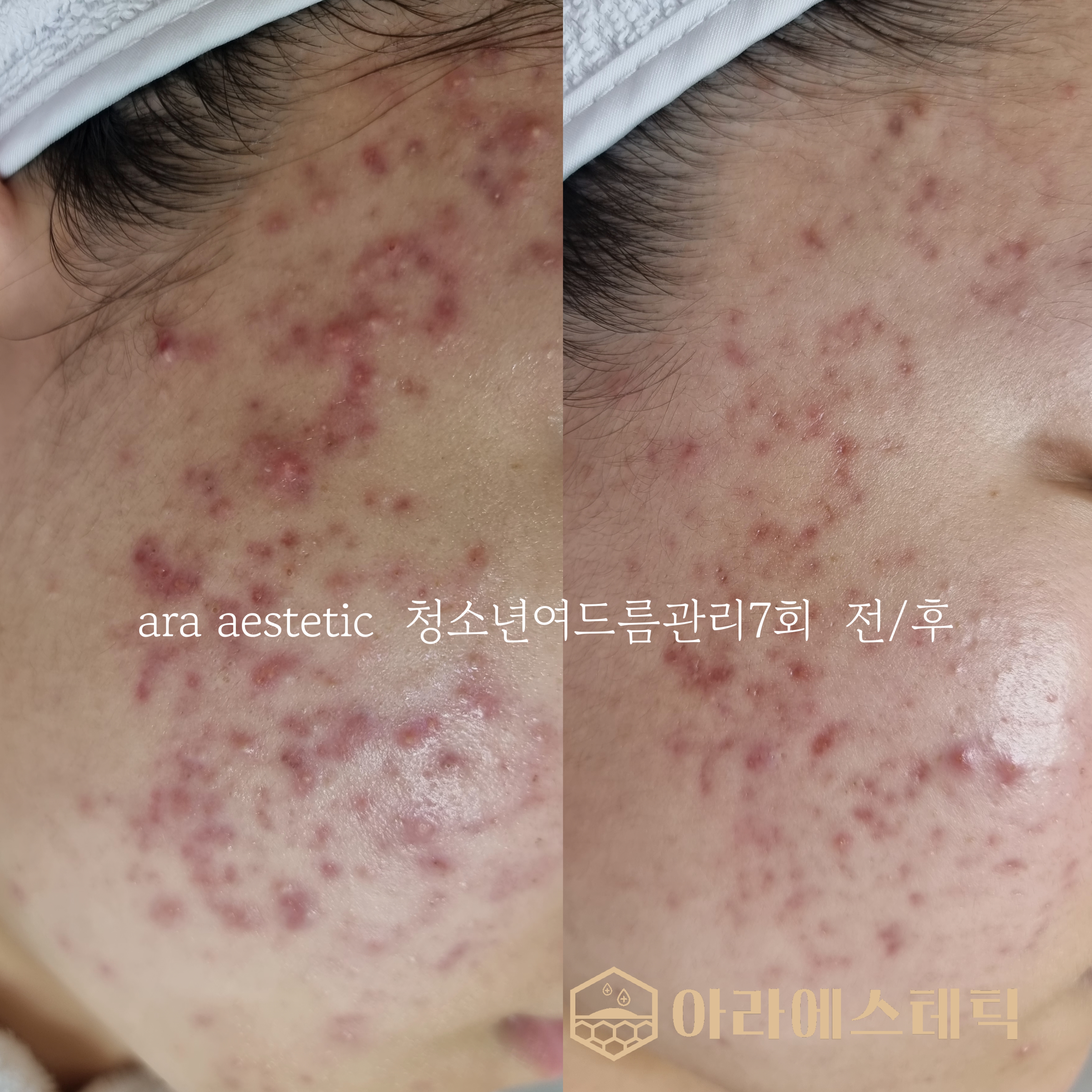 아라에스테틱 광주점 대표 이미지