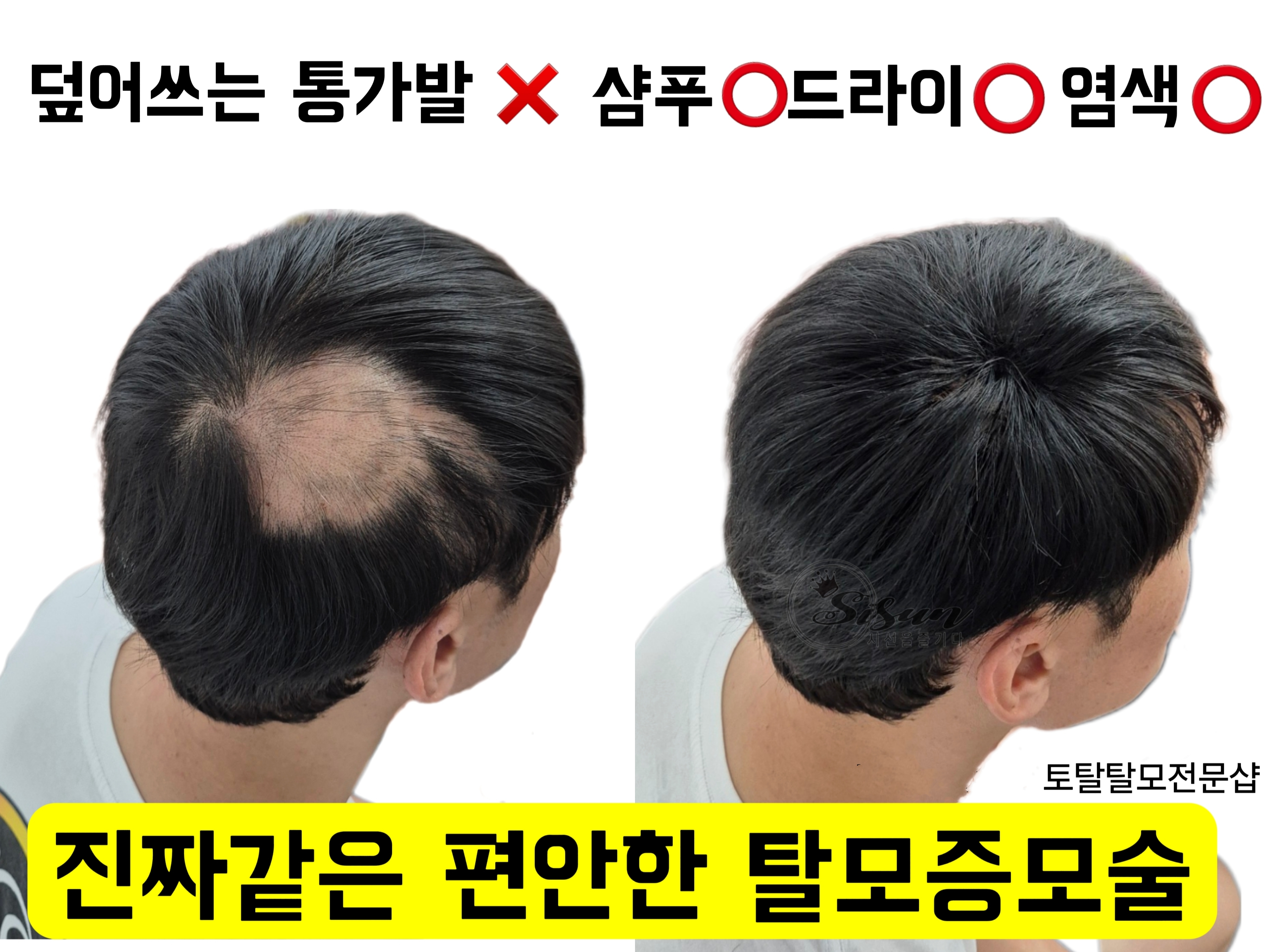 시선을즐기다 토탈 탈모 두피커버 전문샵