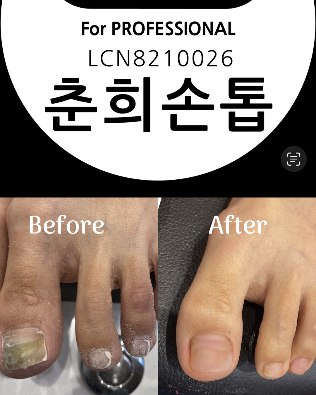 춘희손톱 대표 이미지